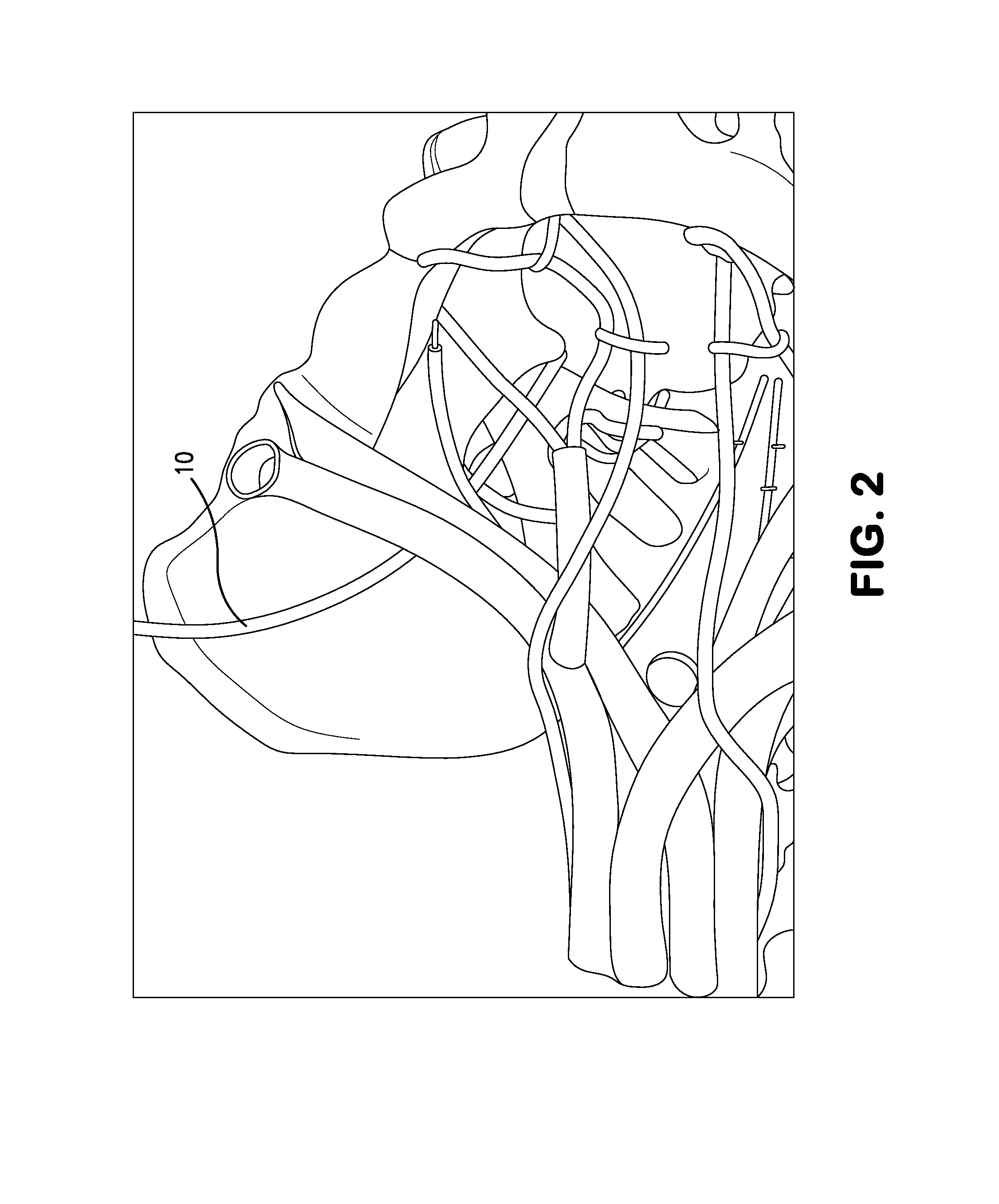 System and method for implantation of lead and electrodes to the endopelvic portion of the pelvic nerves and connection cable for electrode with direction marker