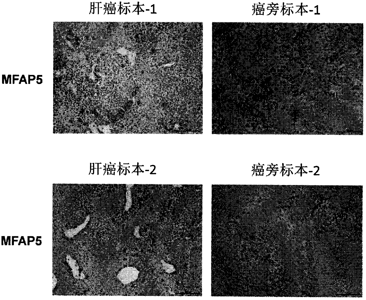 Application of MFAP5 in preparing preparation for screening markers of people sensitive to alpha interferon intervention in liver cancer