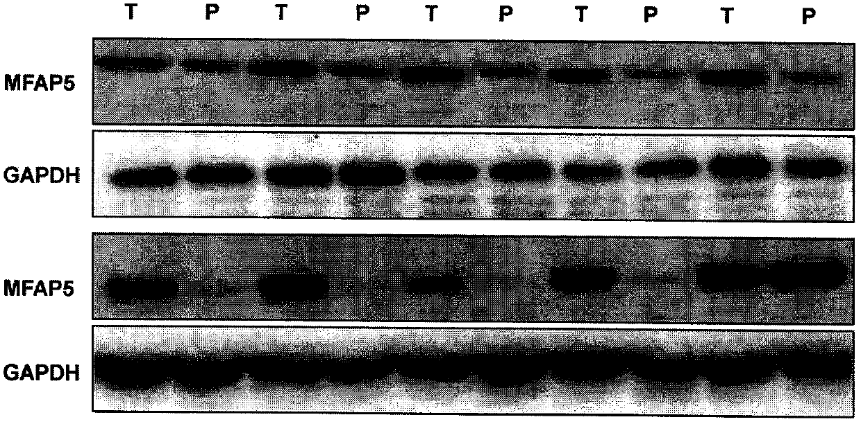 Application of MFAP5 in preparing preparation for screening markers of people sensitive to alpha interferon intervention in liver cancer