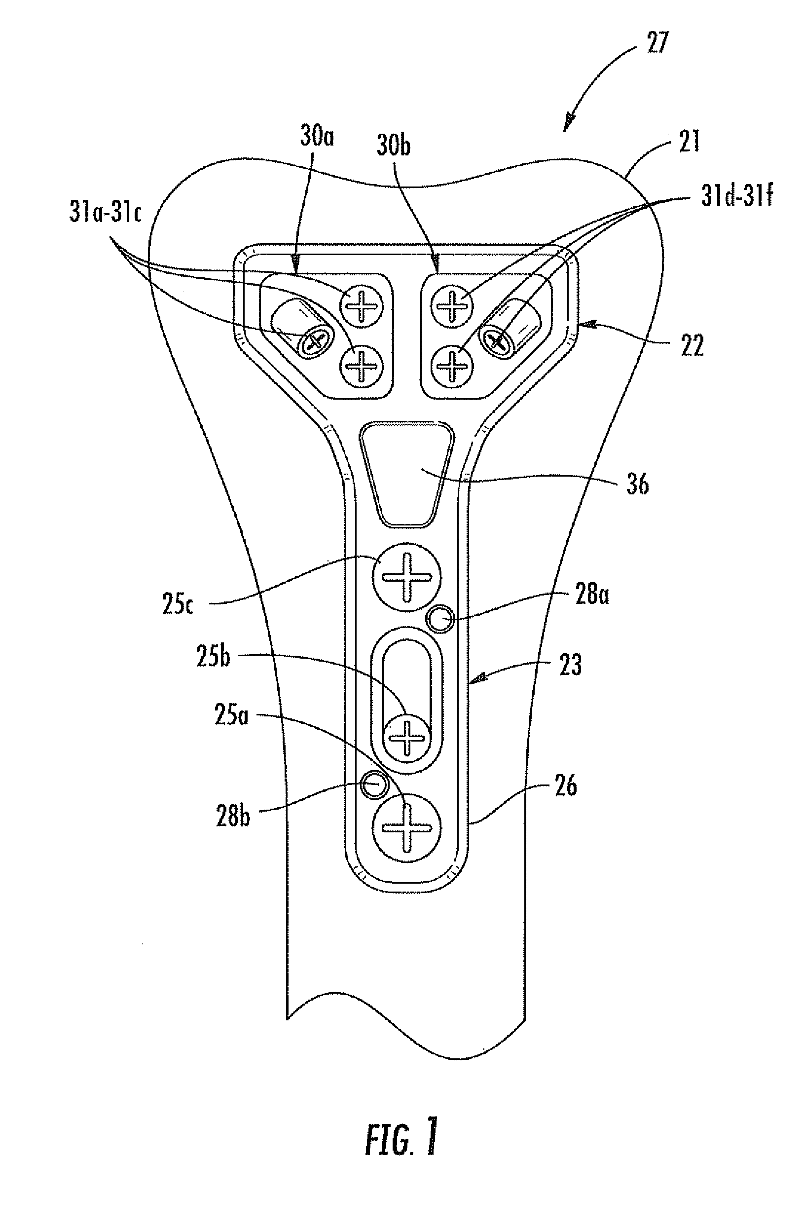Modular bone fixation device for treatment of fractures and related methods