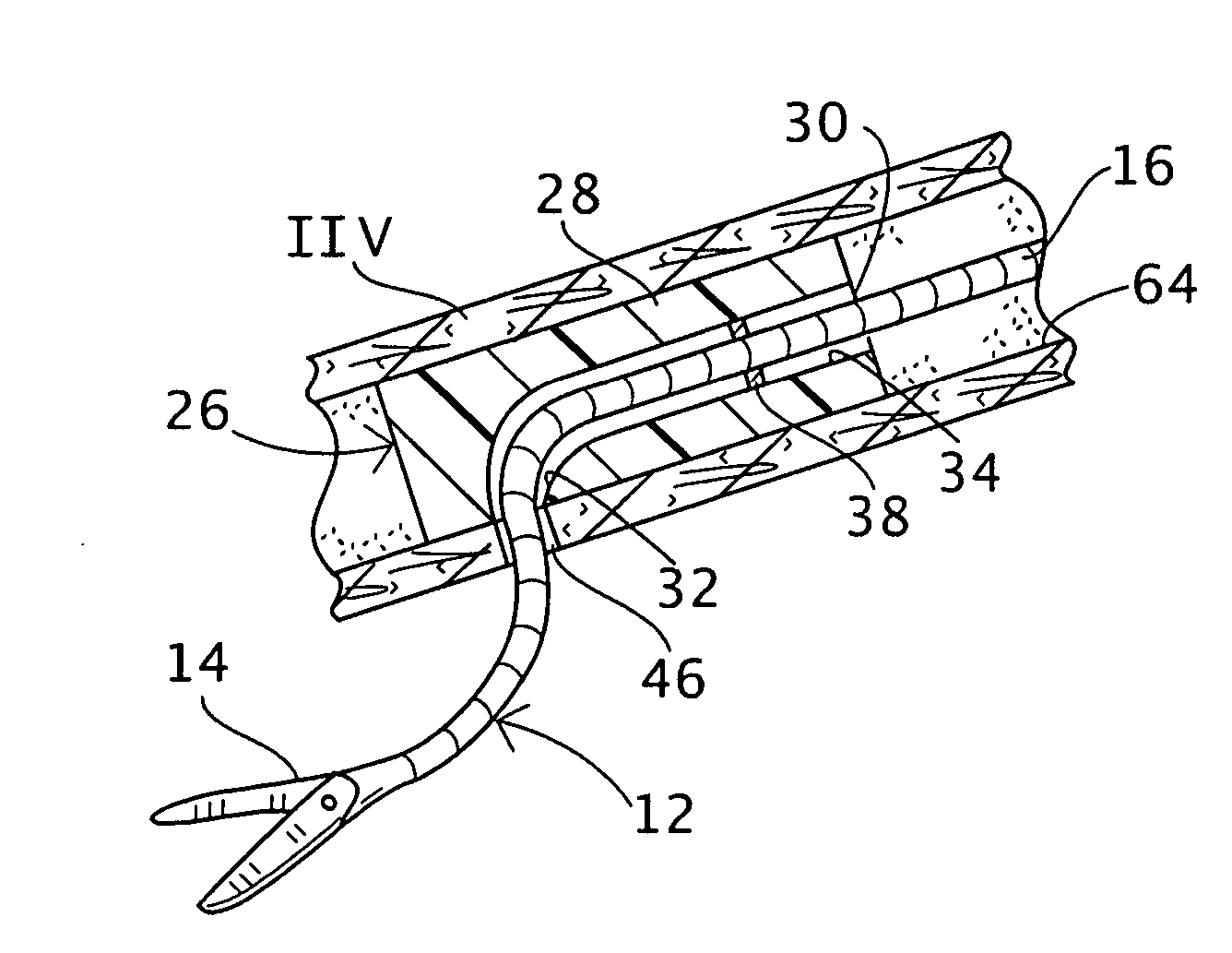Trans-vascular surgical method and associated device