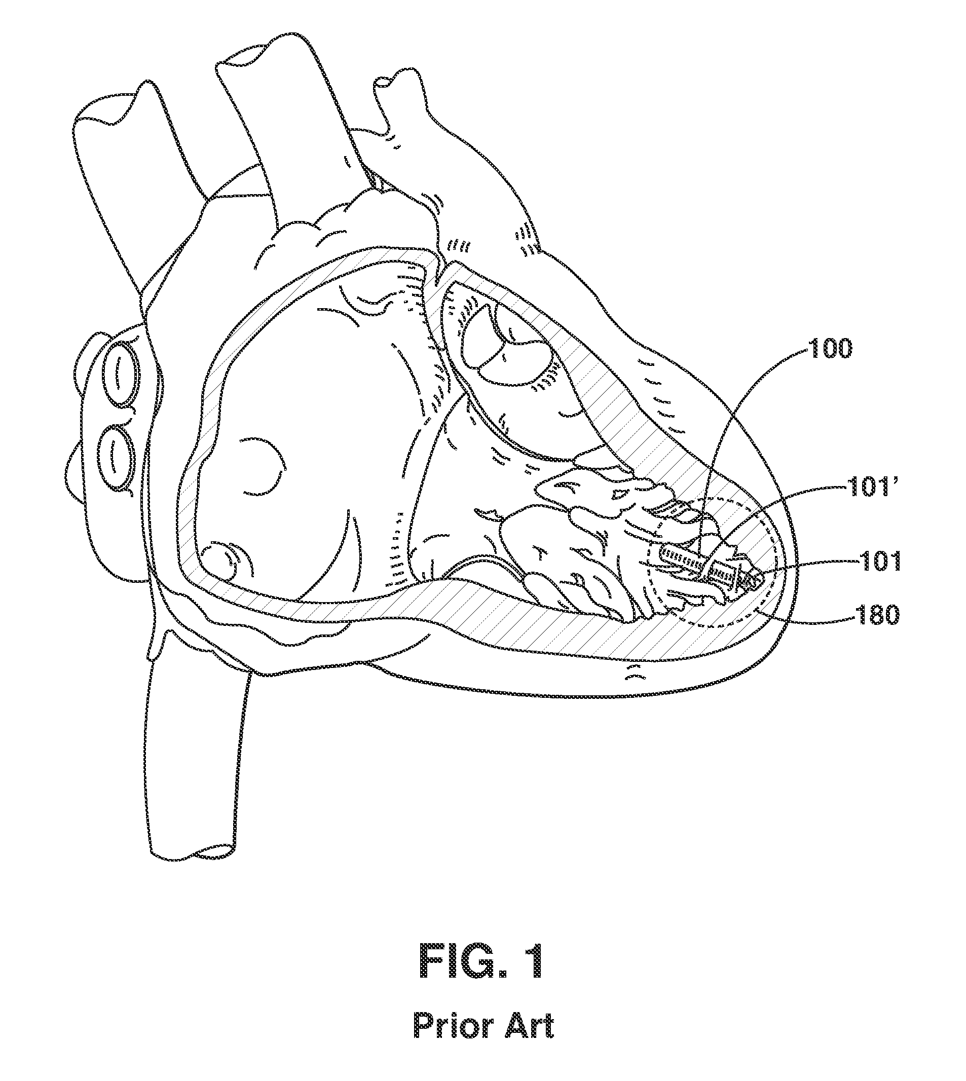 Two-Stage Delivery Systems and Methods for Fixing a Leadless Implant to Tissue