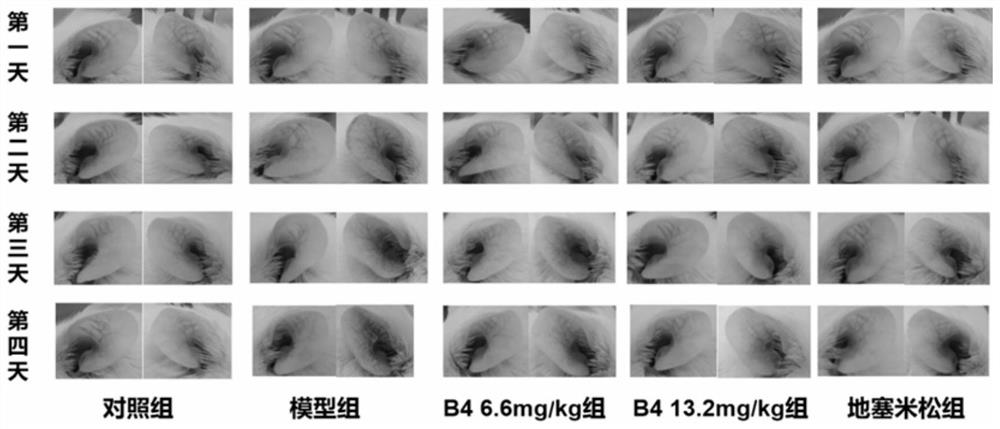 Application of hydroxybetulinic acid compound in preparation of dermatosis drugs