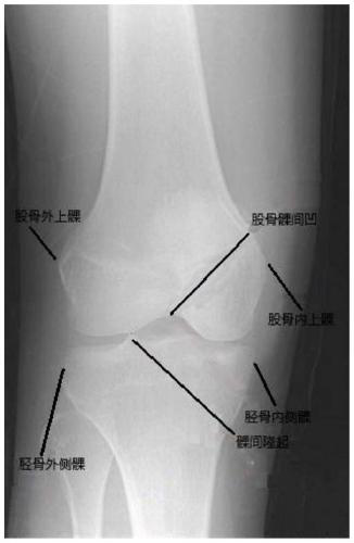 Knee joint posture measuring method based on feature point 3D reconstruction