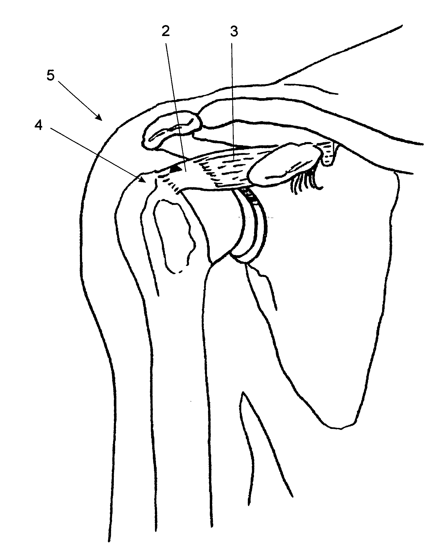 Method of repairing tendons by surgery