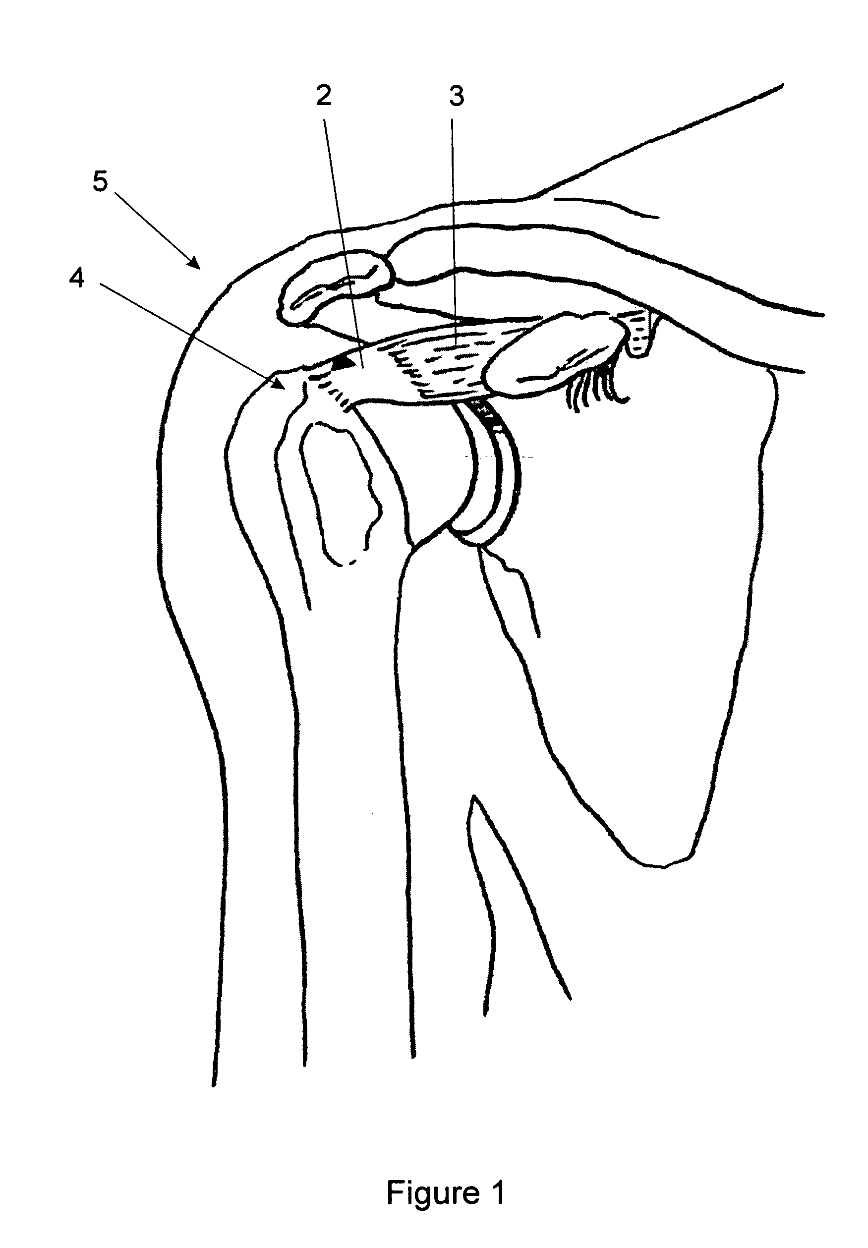 Method of repairing tendons by surgery