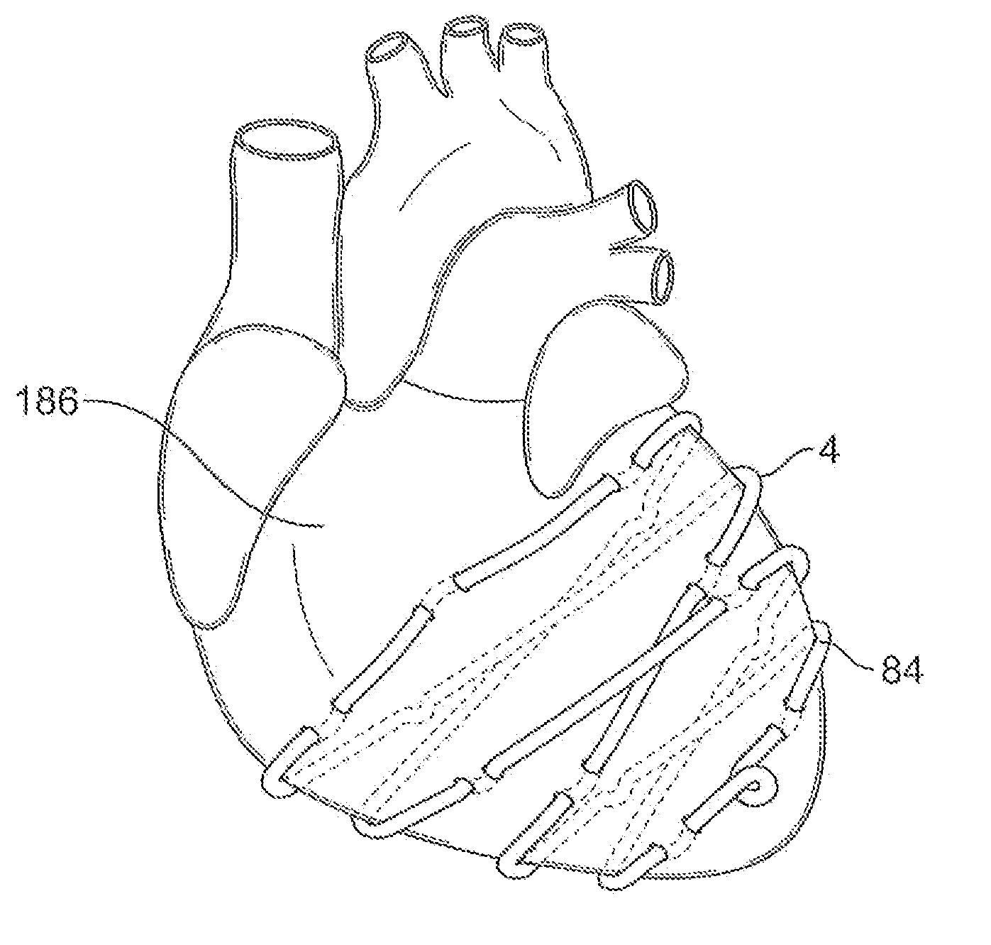 Systems for heart treatment