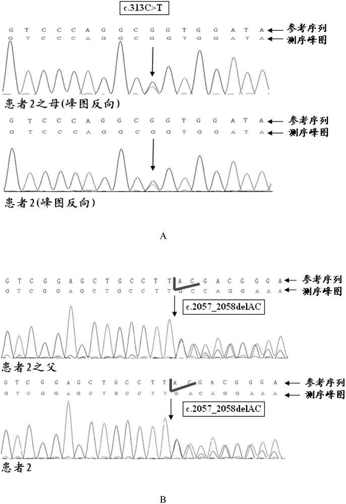 Skeletal Muscle Chloride Channel Gene Mutant and Its Application
