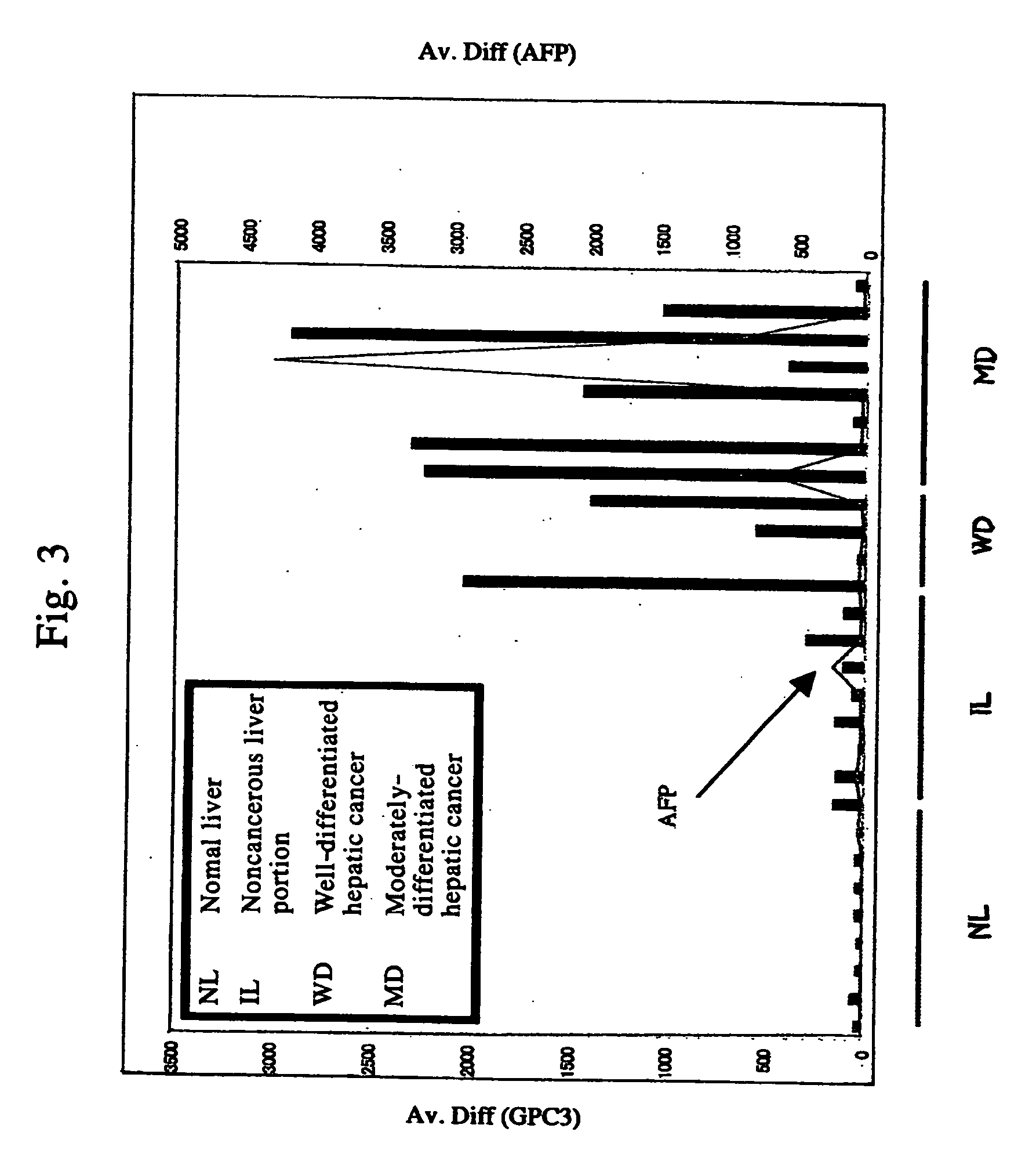 Method for diagnosing cancer by detecting gpc3