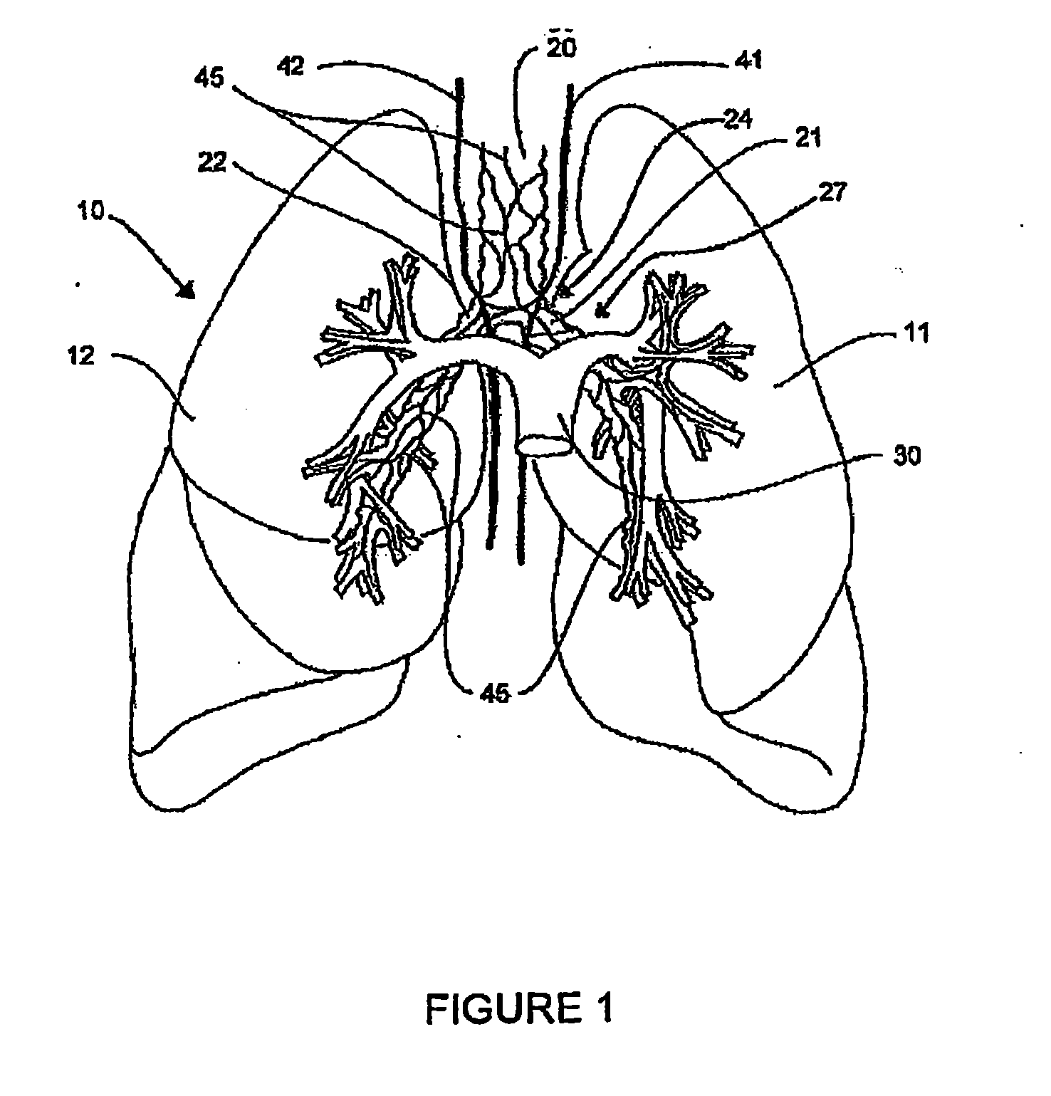 Systems, assemblies, and methods for treating a bronchial tree