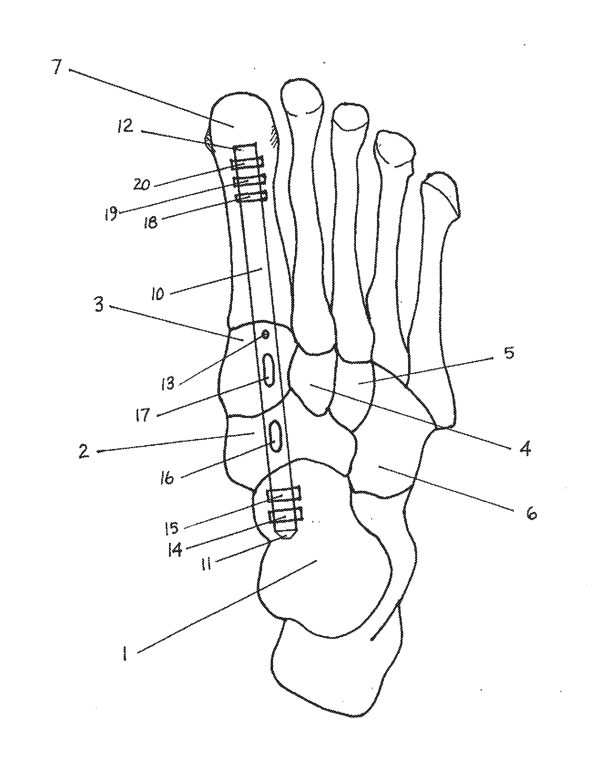 Method and Apparatus for Repairing the Mid-Foot Region Via an Intramedullary Nail