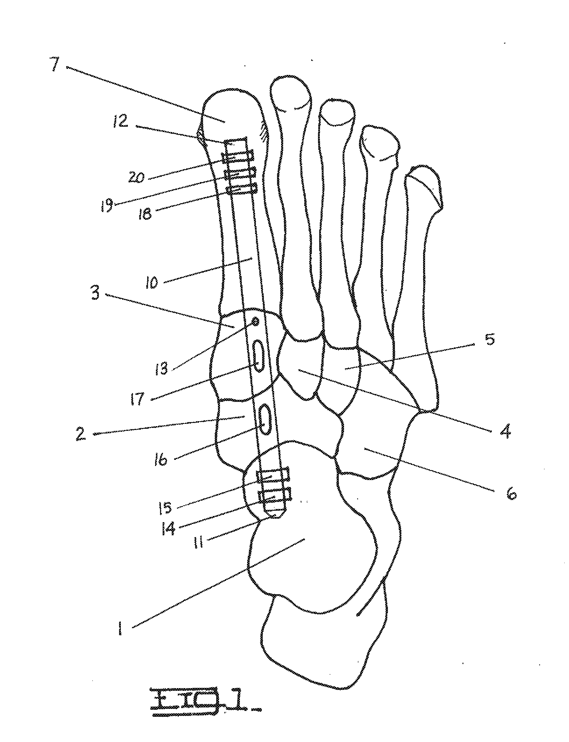 Method and Apparatus for Repairing the Mid-Foot Region Via an Intramedullary Nail