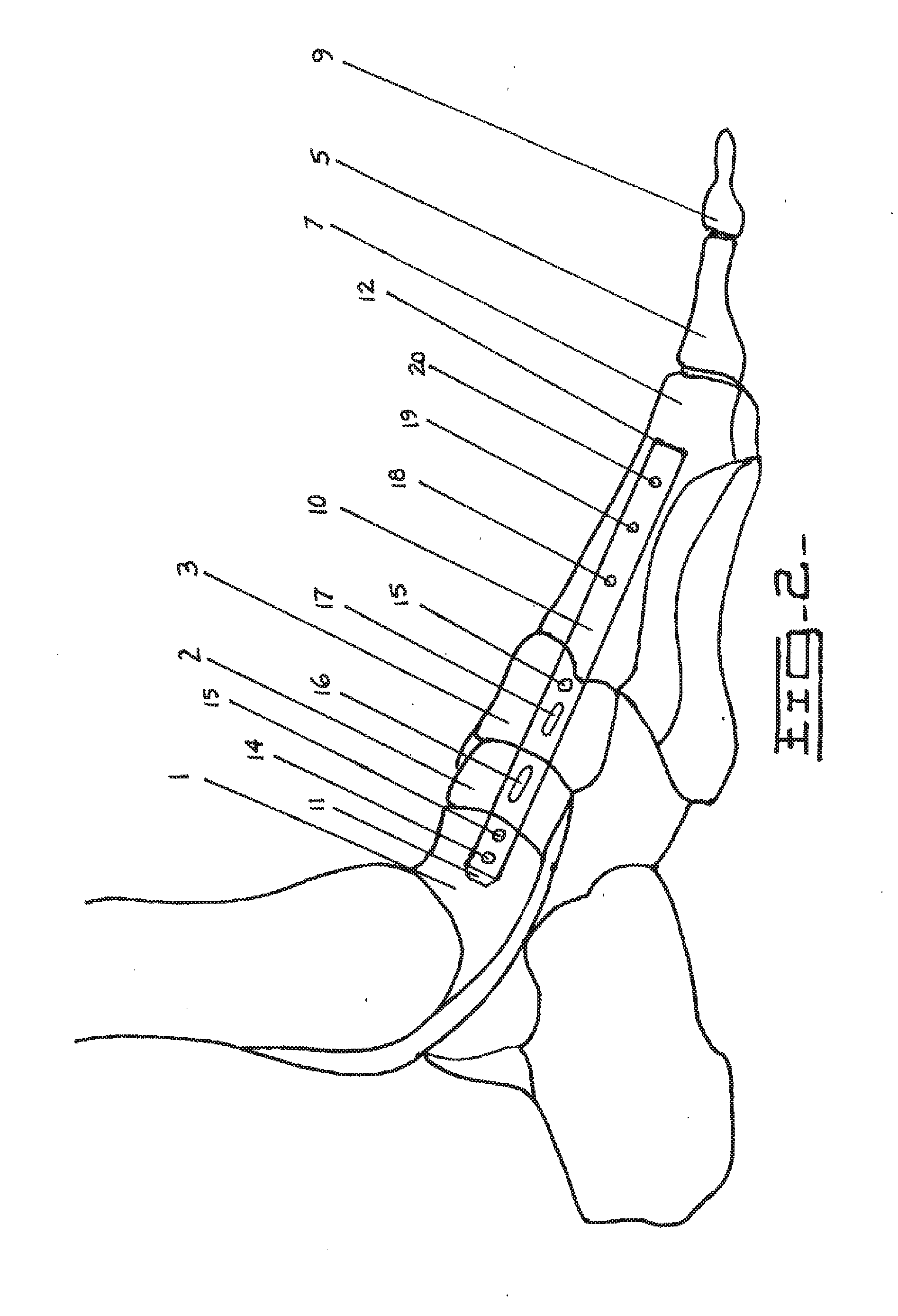 Method and Apparatus for Repairing the Mid-Foot Region Via an Intramedullary Nail