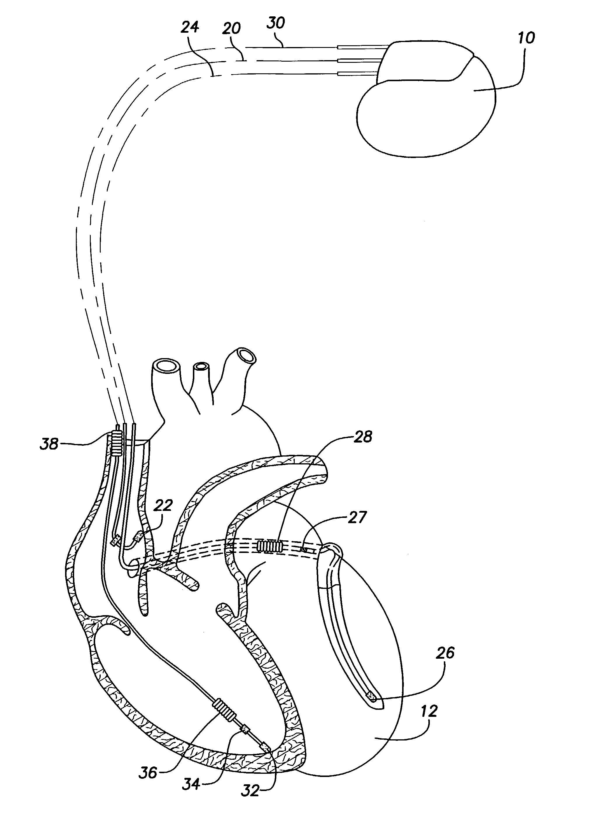 System and method for determining patient posture based on 3-D trajectory using an implantable medical device
