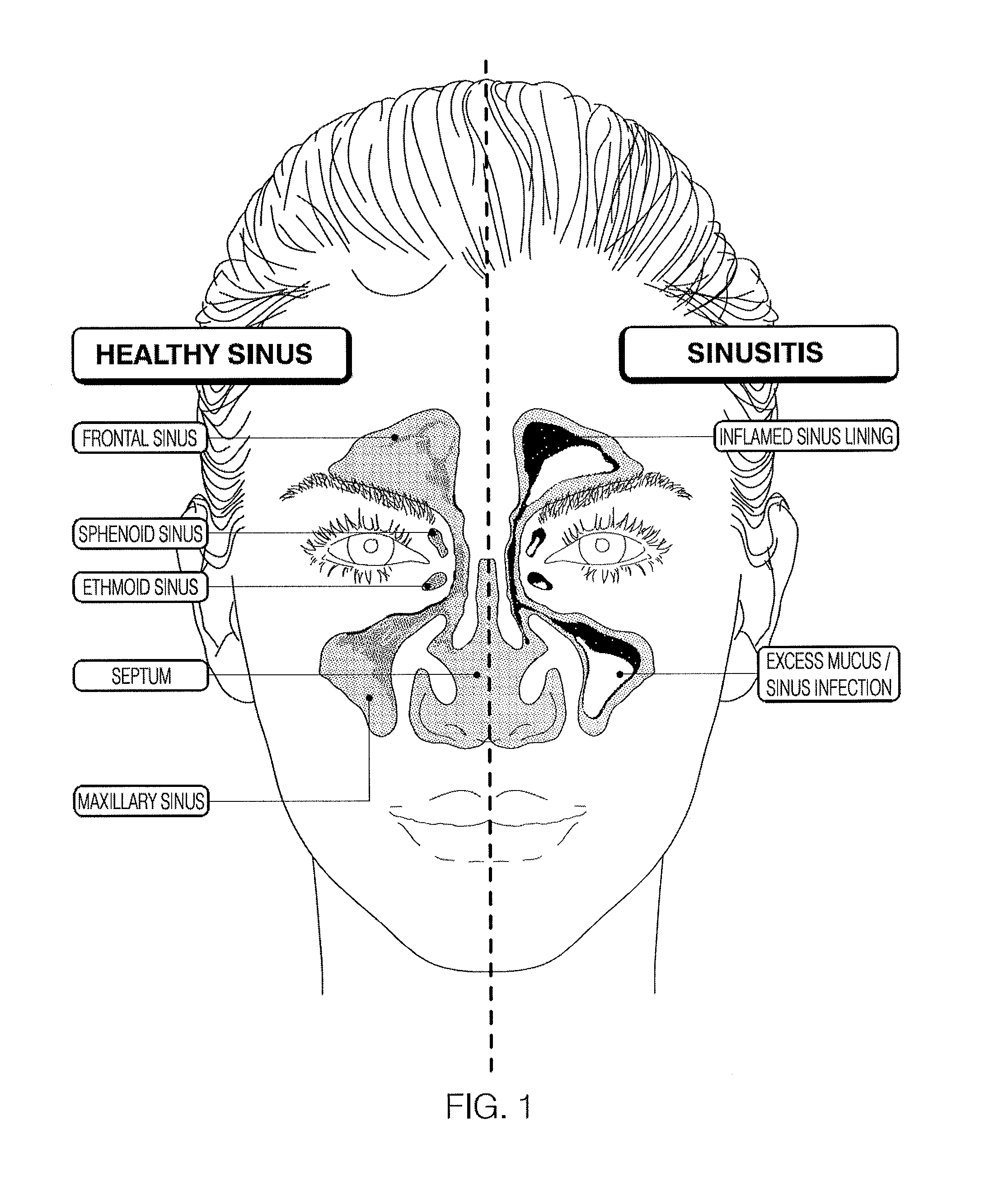 Devices and assays for diagnosis of sinusitis