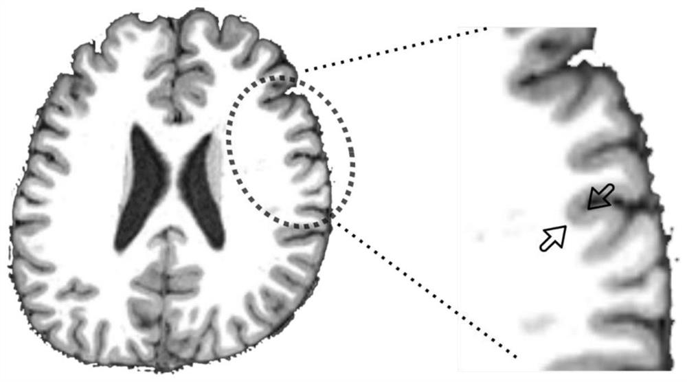 Method for fusing MRI morphological multiple indexes