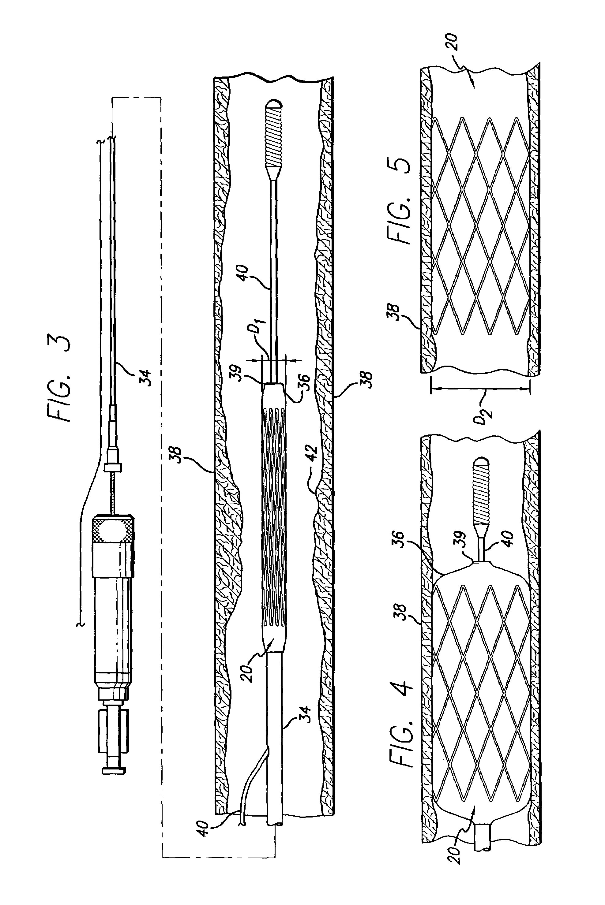 Medical device made from self-stiffening composite