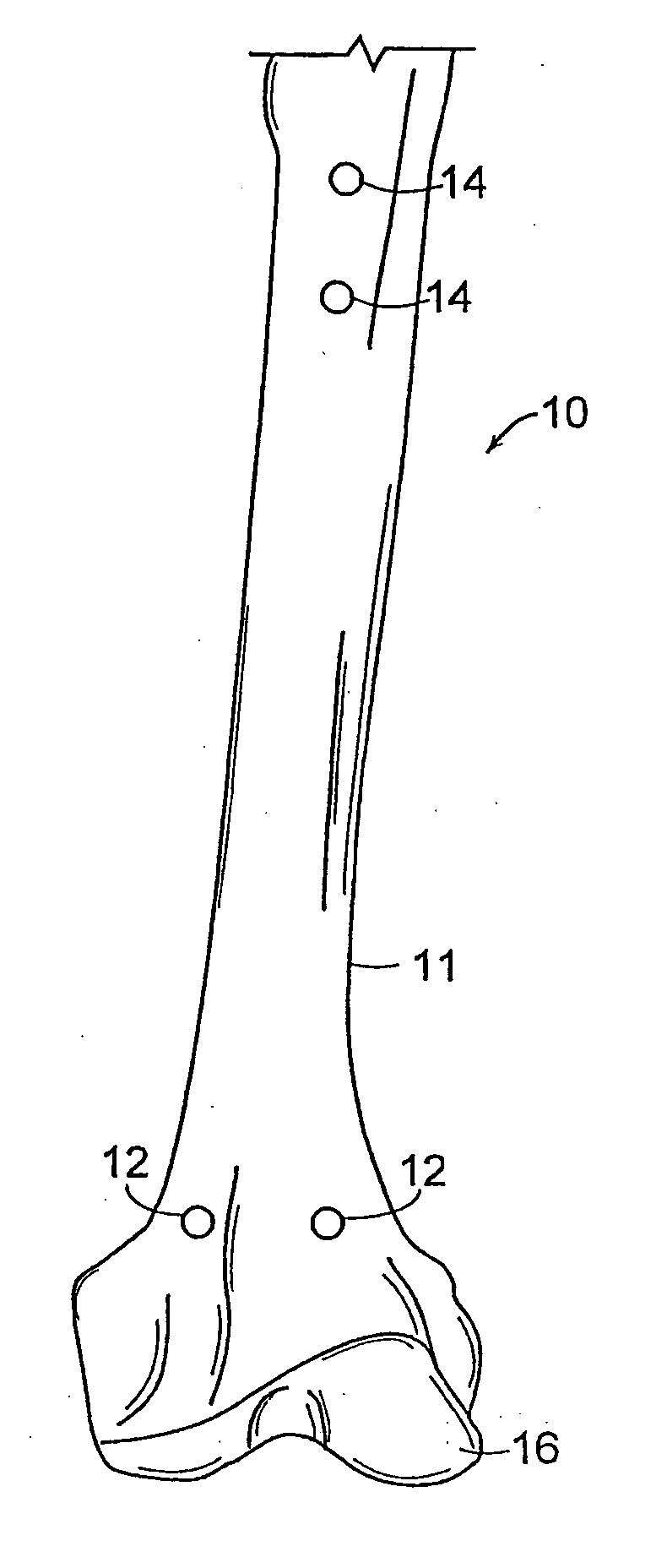 Systems and methods for producing osteotomies