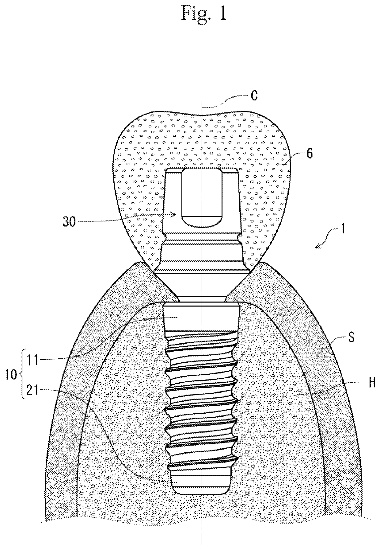 Fixture and implant