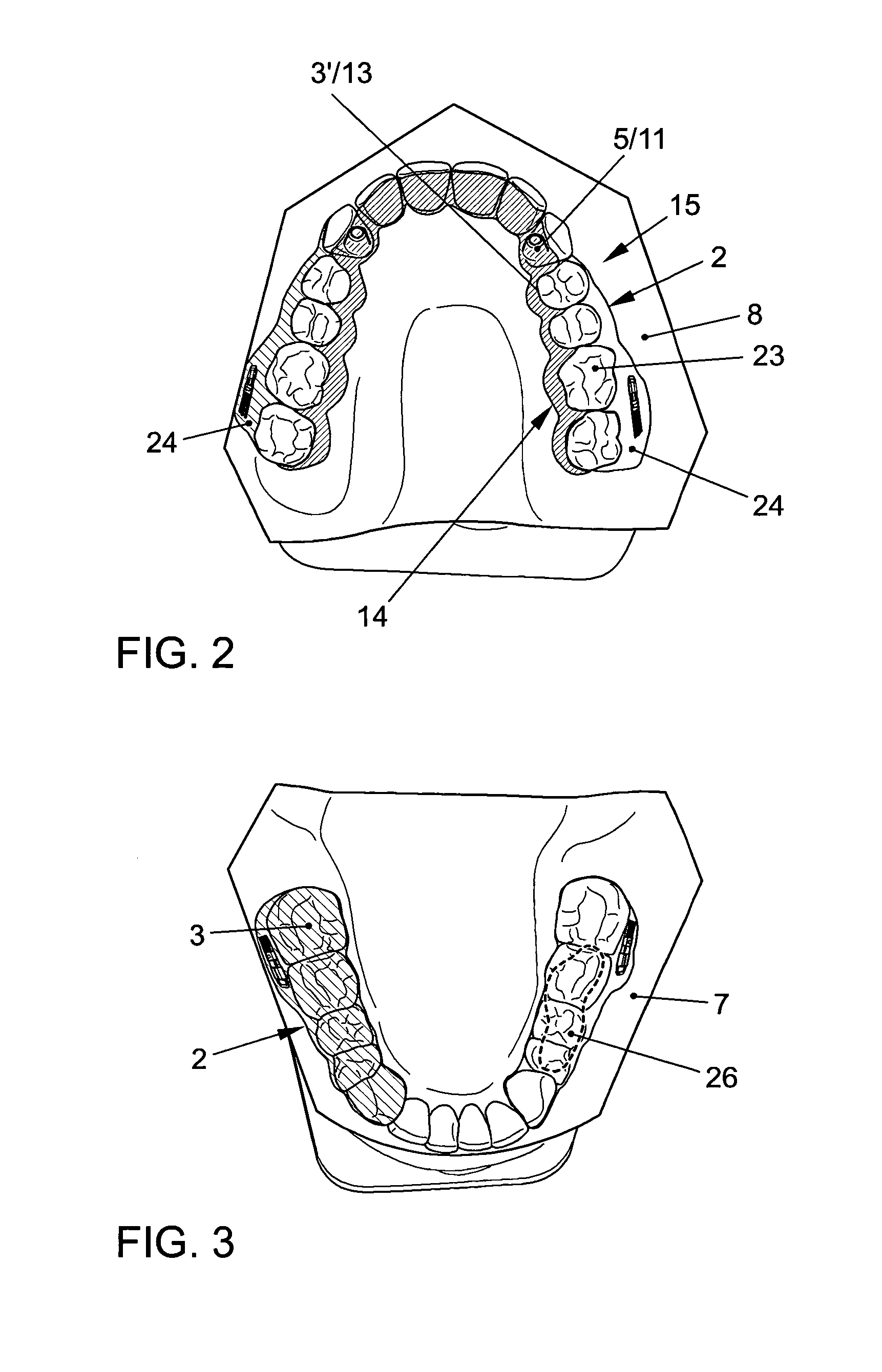 Apparatus for temporomandibular joint-related corrections of tooth position
