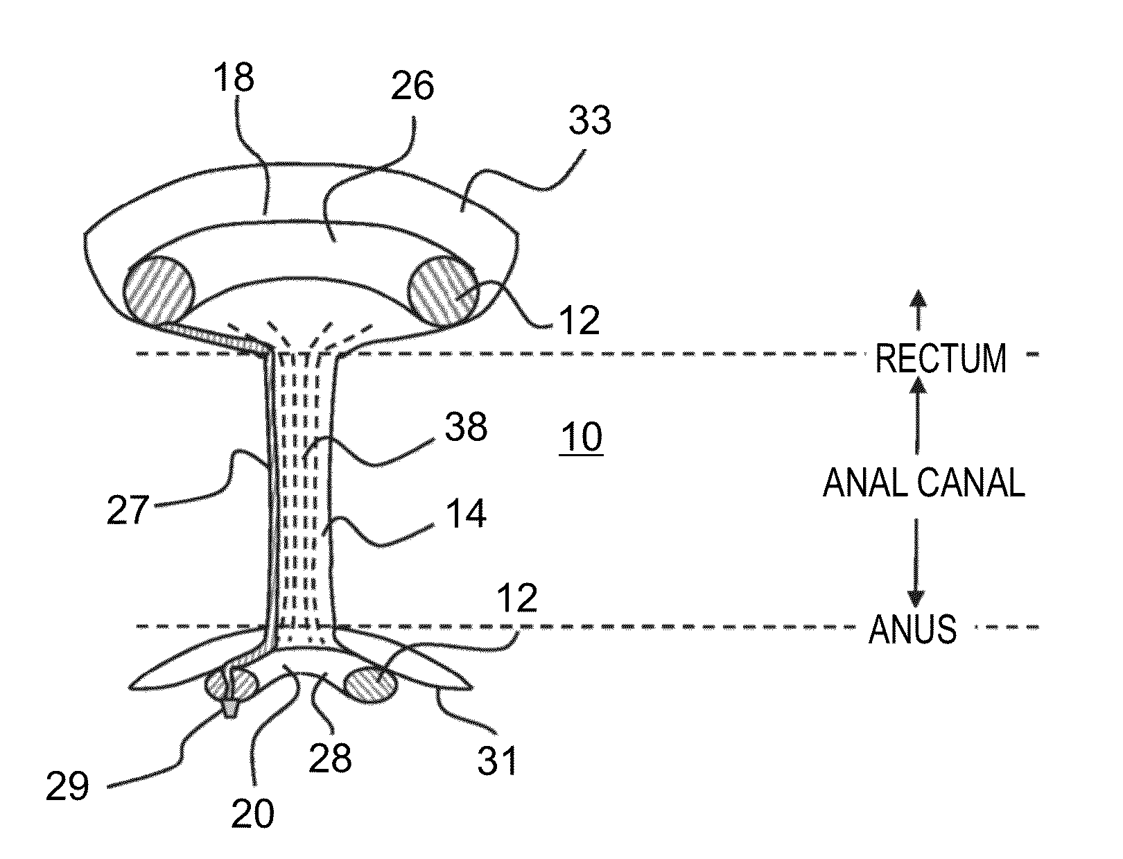 Device for protecting hemorrhoids