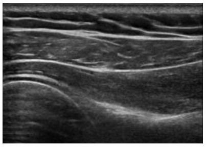 Shoulder muscle bone ultrasonic structure segmentation method based on semi-supervised semantic segmentation