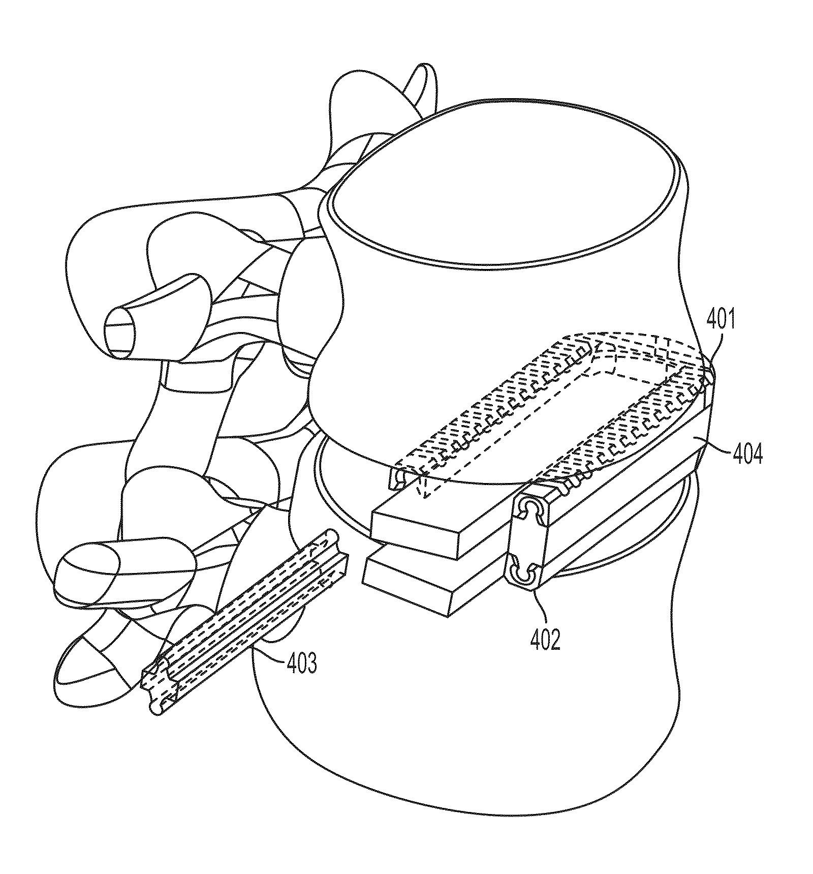 Interbody fusion device with separable retention component for lateral approach and associated methods
