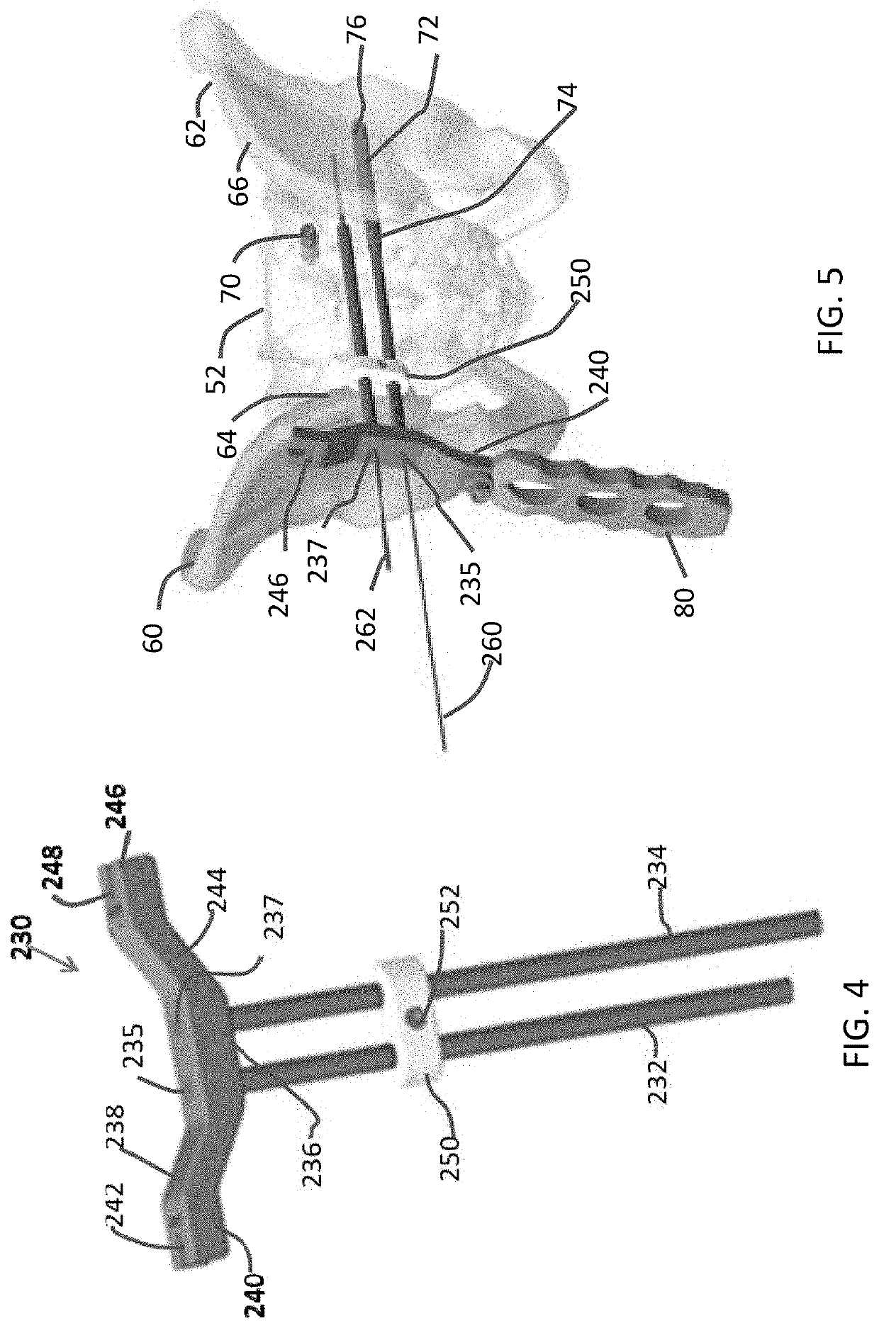 Method and apparatus for performing medial-to-lateral sacroiliac fusion