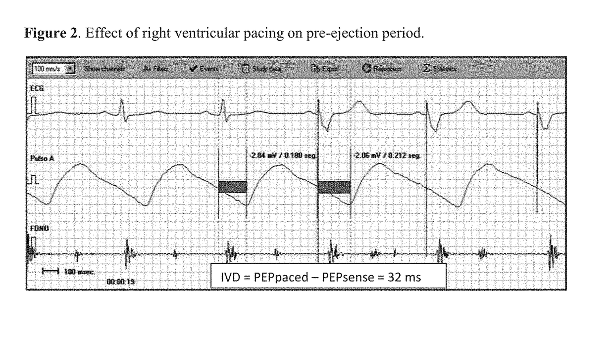 Device and Method for Assessment of Left Ventricular Ejection Fraction and Other Parameters of Cardiac Performance