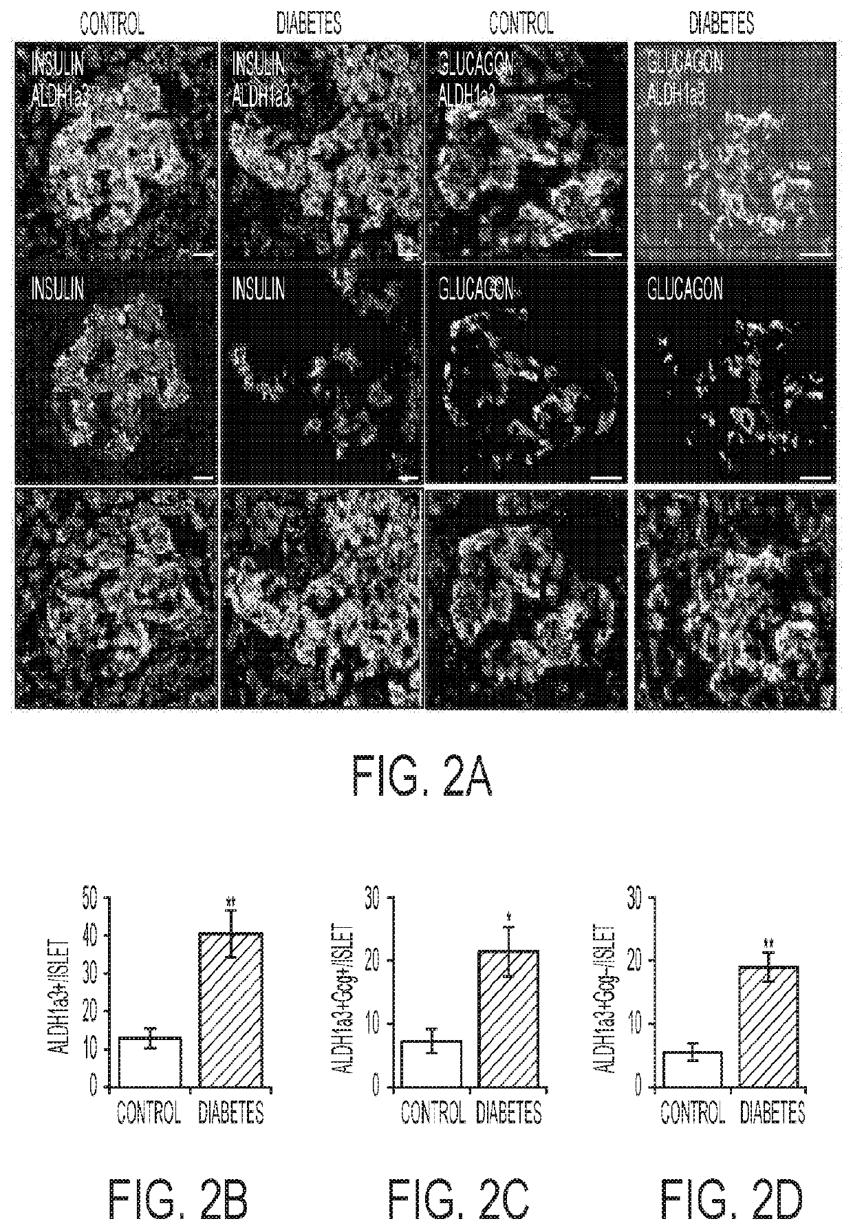 Use of aldehyde dehydrogenase as biomarker for beta-cell dysfunction and loss
