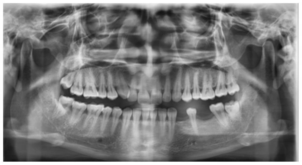 A device and orthodontic method for moving molars by distraction osteogenesis of periodontal ligament