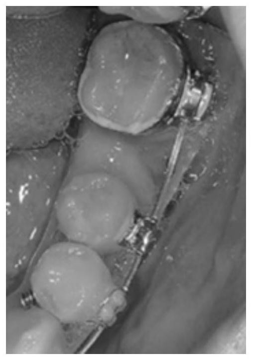 A device and orthodontic method for moving molars by distraction osteogenesis of periodontal ligament