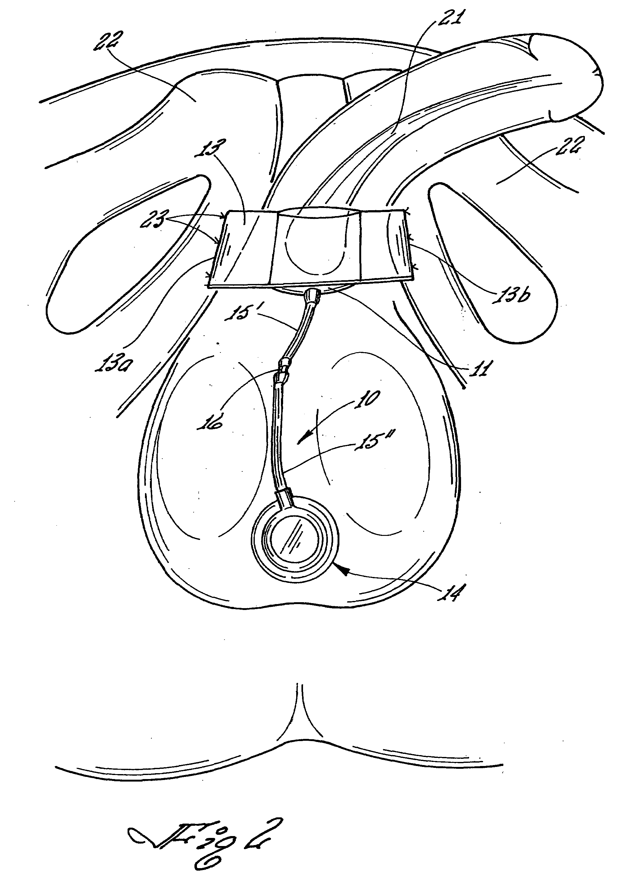 Adjustable implantable male incontinence device