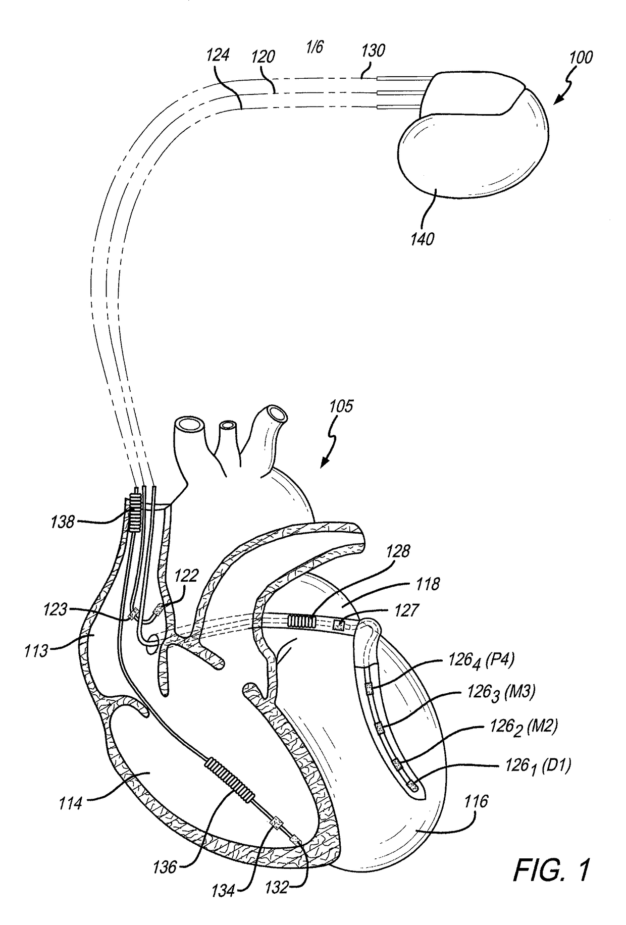 Method and System for Adaptive Bi-Ventricular Fusion Pacing