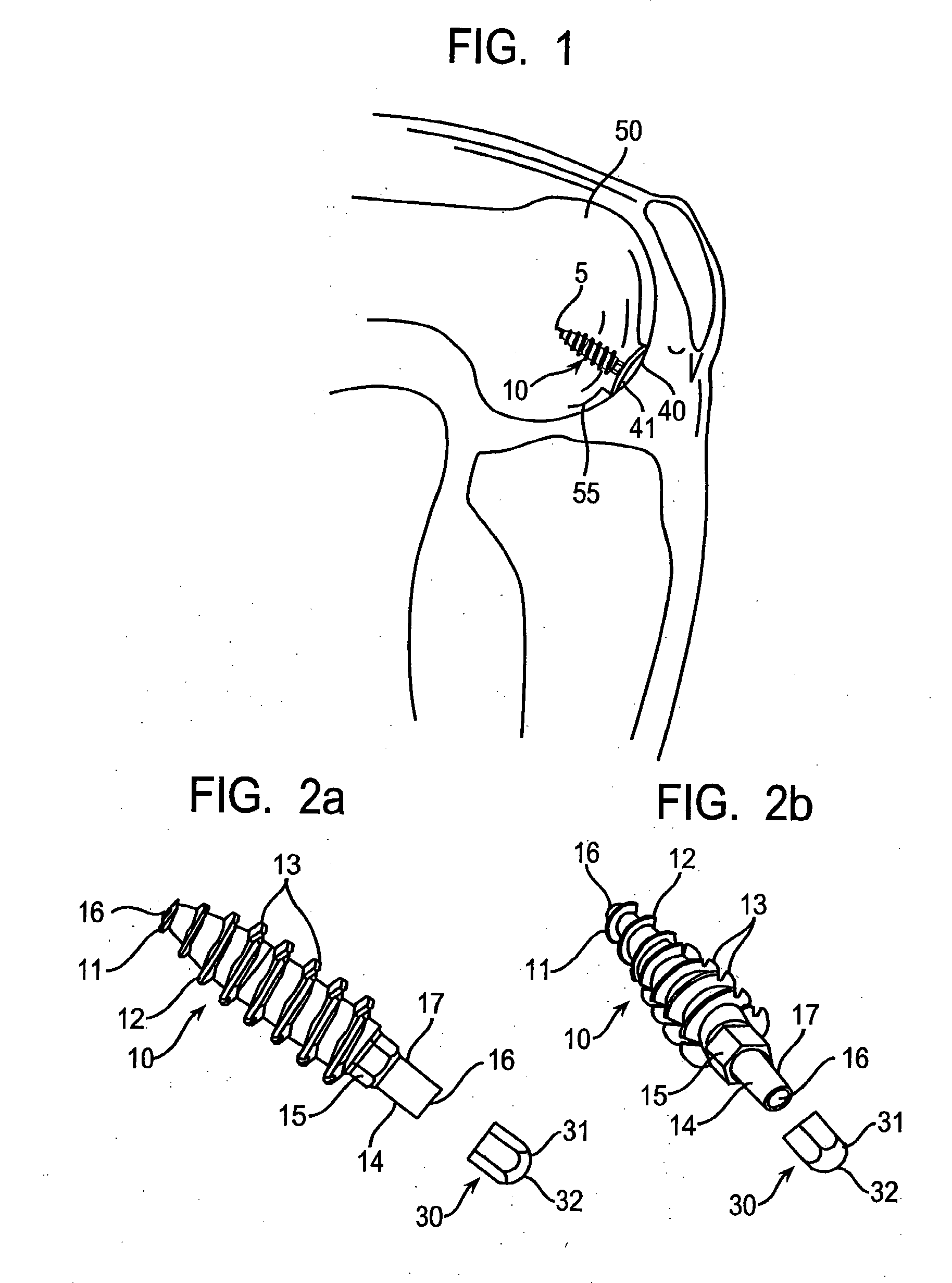 System and Method for Joint Resurface Repair