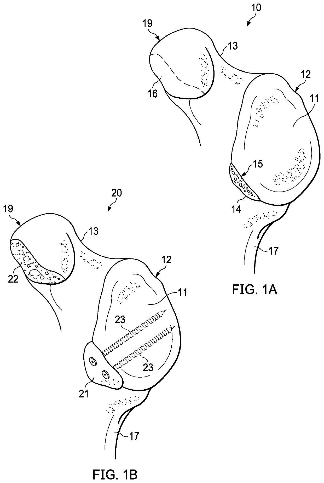 Glenoid bone graft retention plate