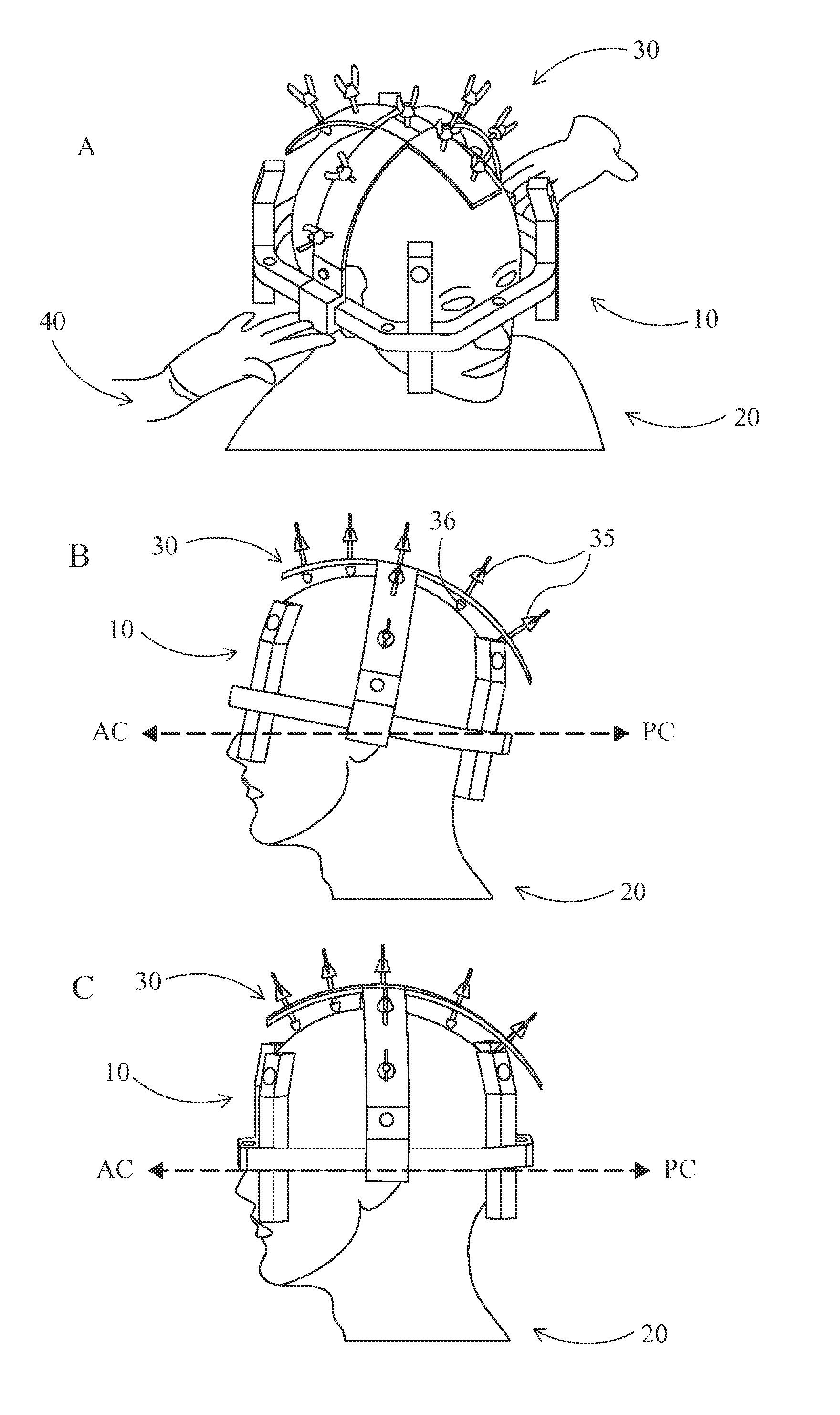 Devices and methods for positioning a stereotactic frame