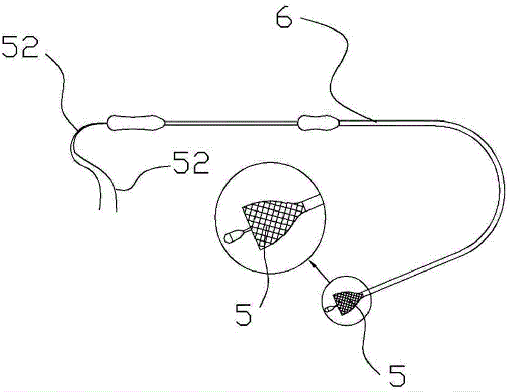 Anti-displacement esophageal stent apparatus bag
