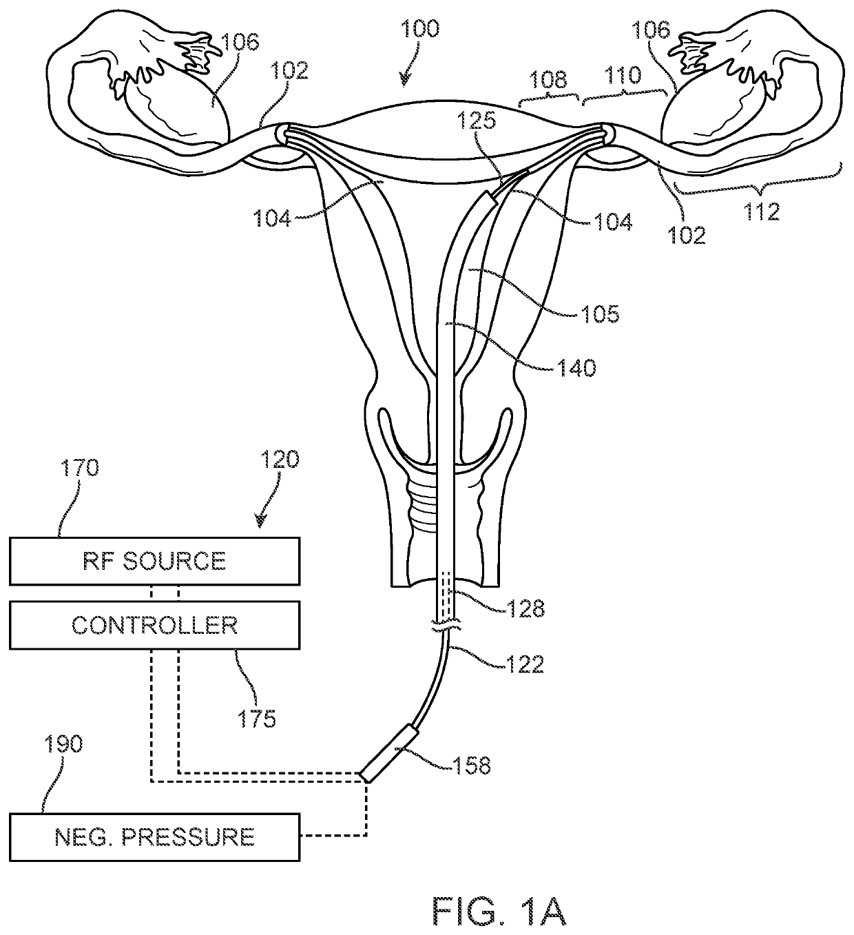 Systems and methods for permanent female contraception