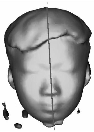 A Symmetry Analysis Method of 3D Face Model