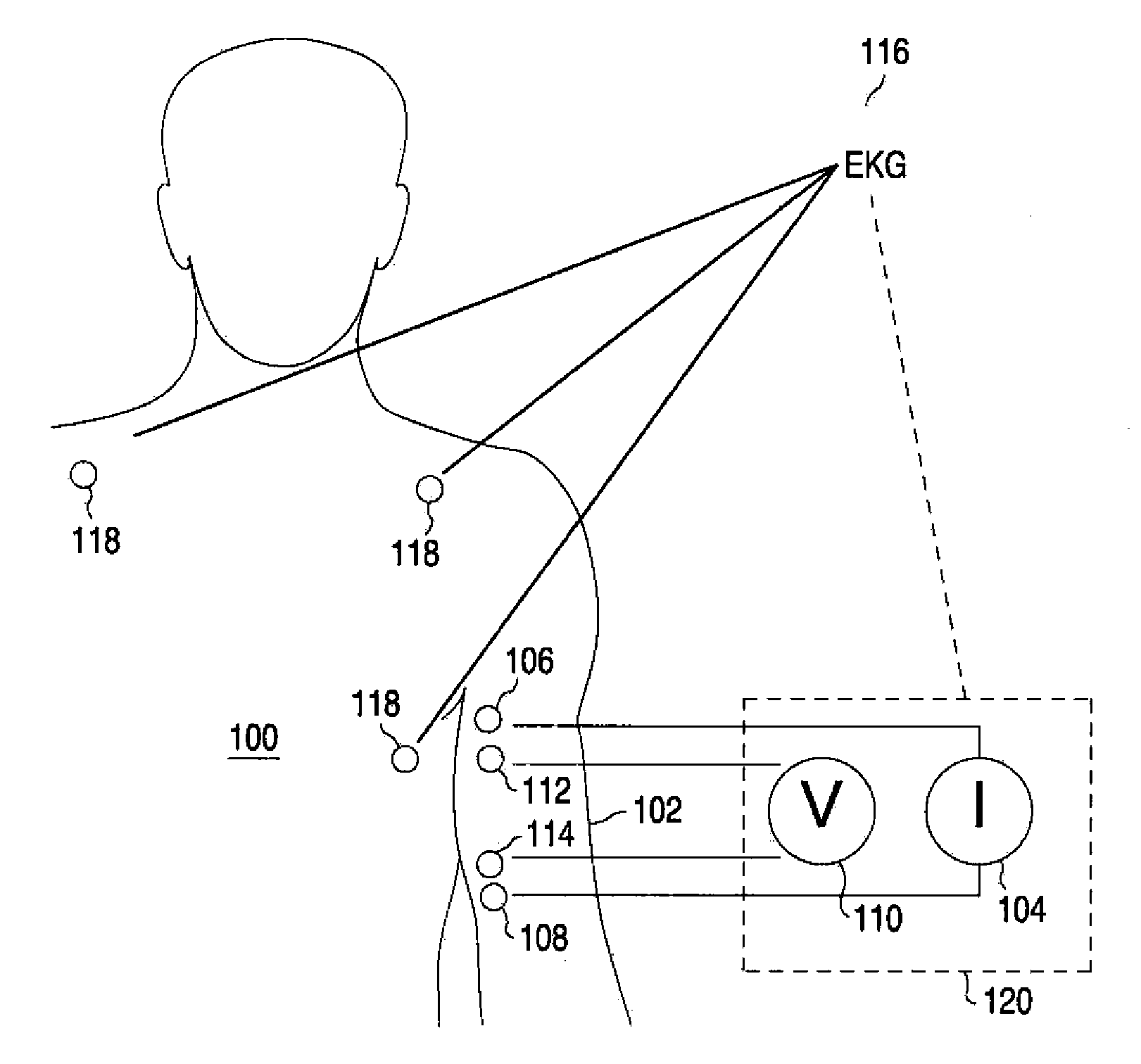 Apparatus And Method For Determination Of Stroke Volume Using The Brachial Artery