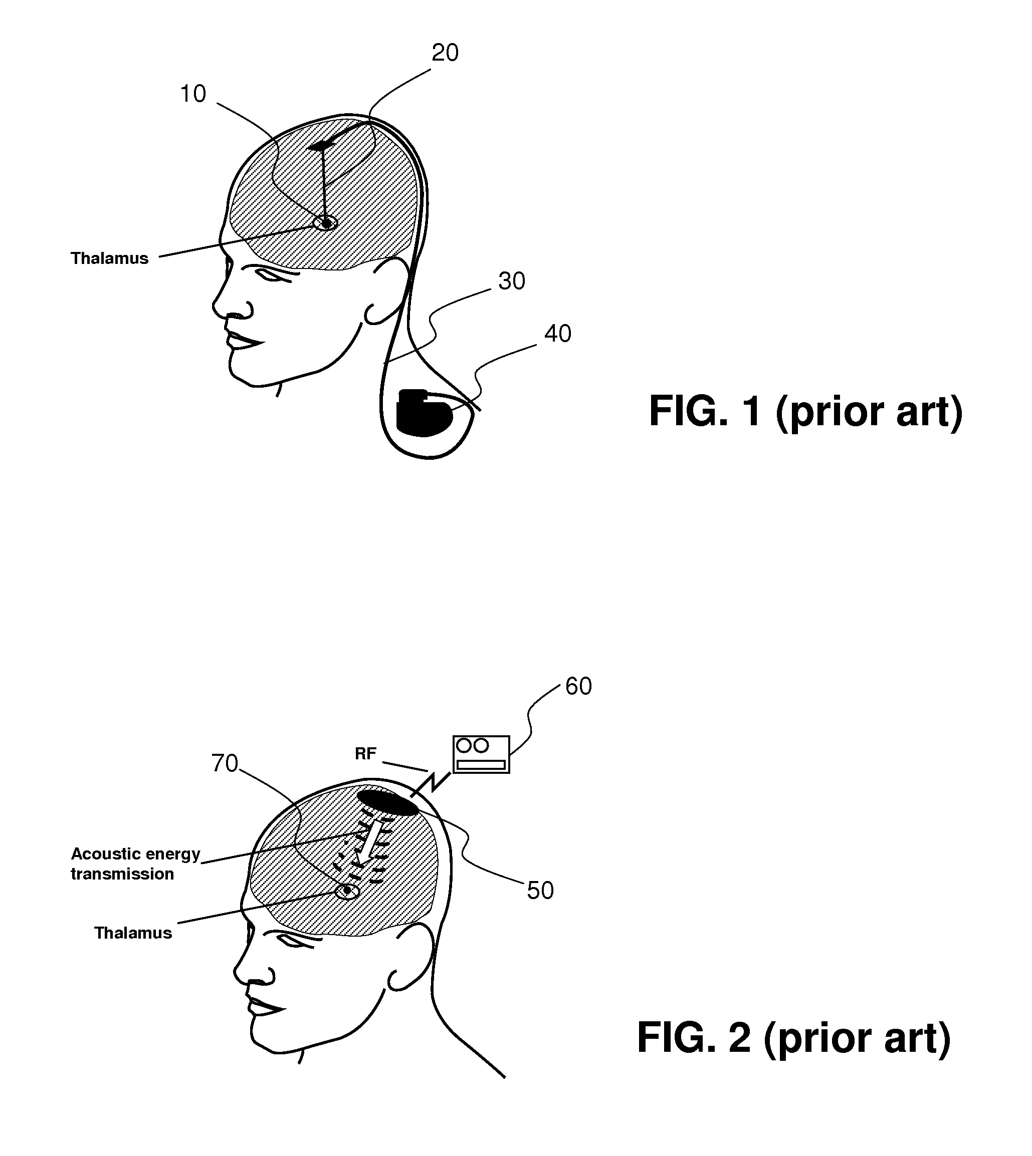 Leadless system for deep brain stimulation using time reversal acoustics
