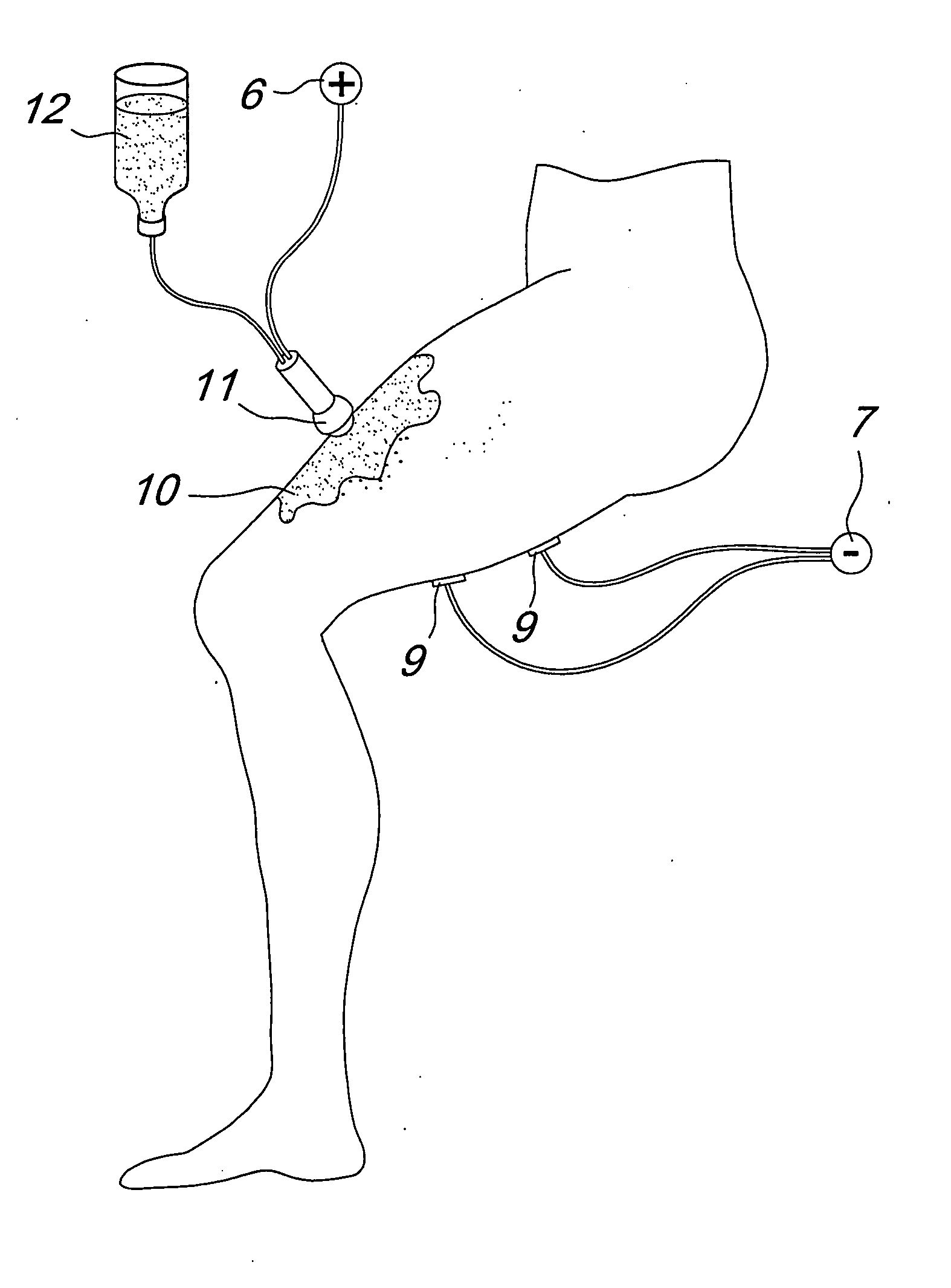 Process for permanent body epilation