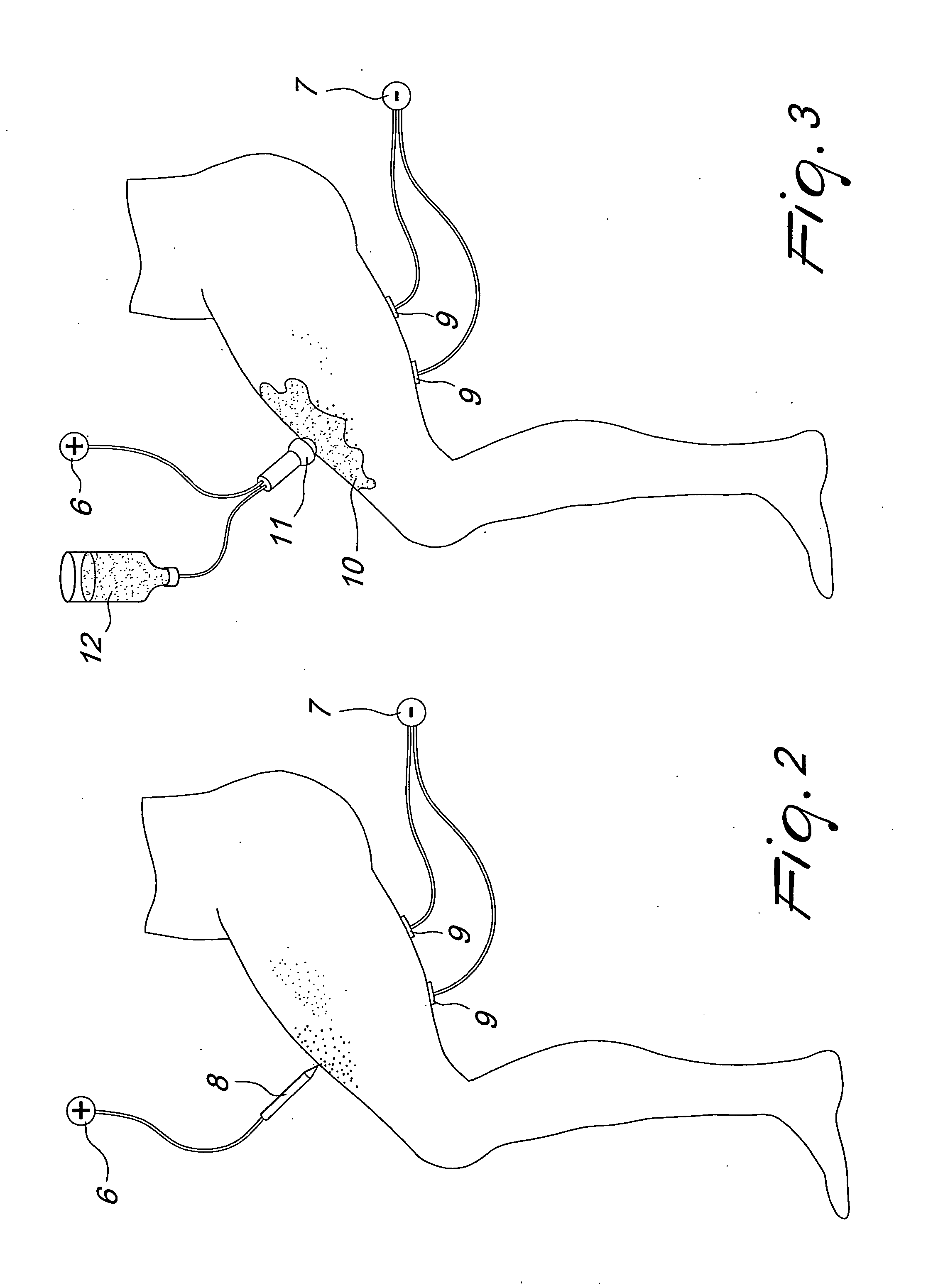 Process for permanent body epilation