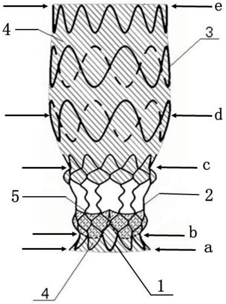 An ascending aortic aortic valve integrated intravascular stent