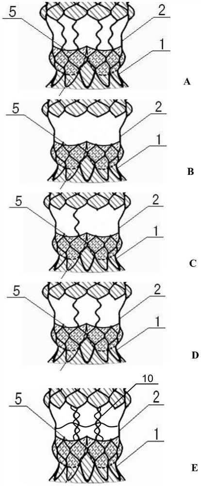 An ascending aortic aortic valve integrated intravascular stent
