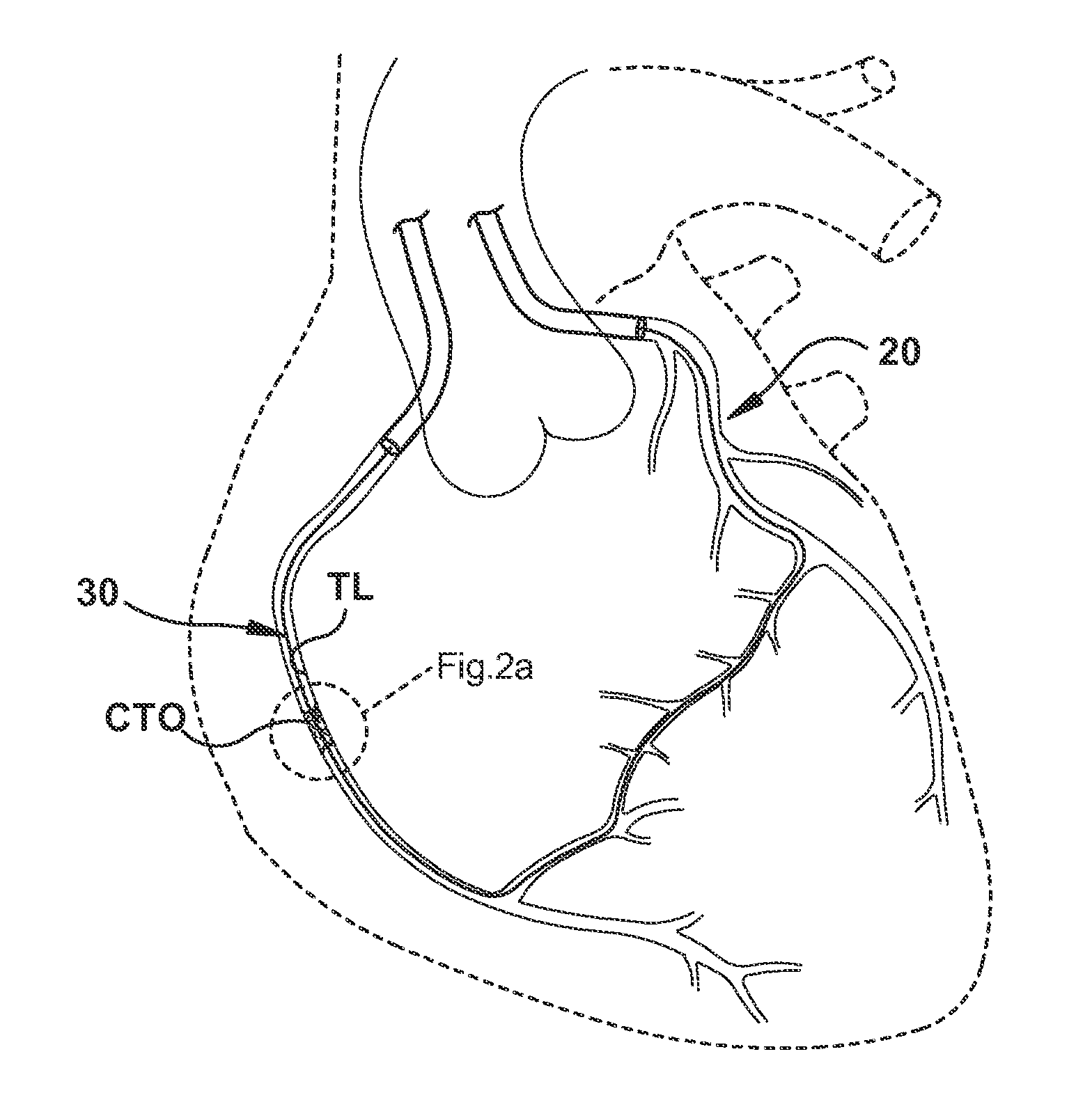Medical Device for Revascularization of Vascular Occlusion and Method for Using Same