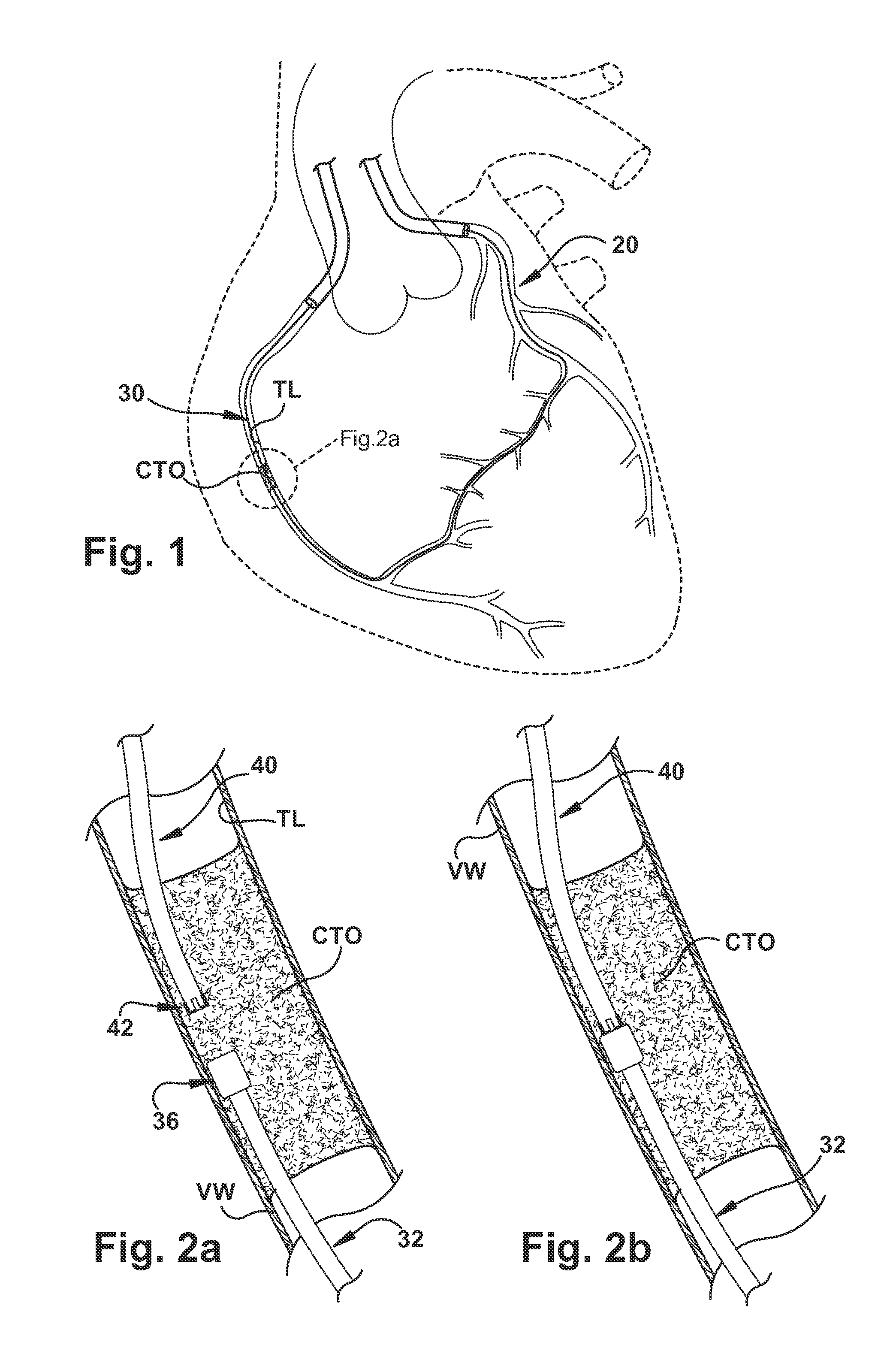 Medical Device for Revascularization of Vascular Occlusion and Method for Using Same