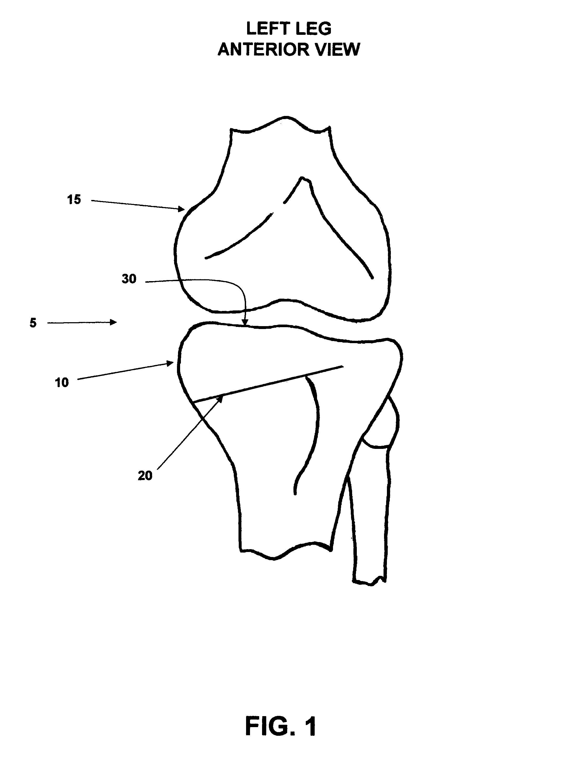 Method and apparatus for performing an open wedge, high tibial osteotomy