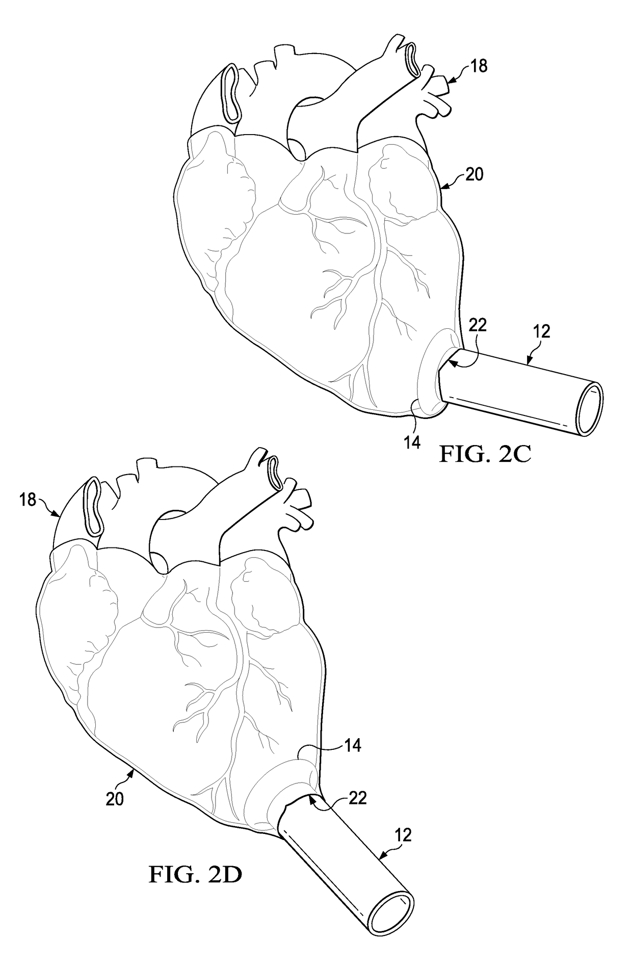 Apparatus and Method for Minimally Invasive Implantation of a Heart Assist Device